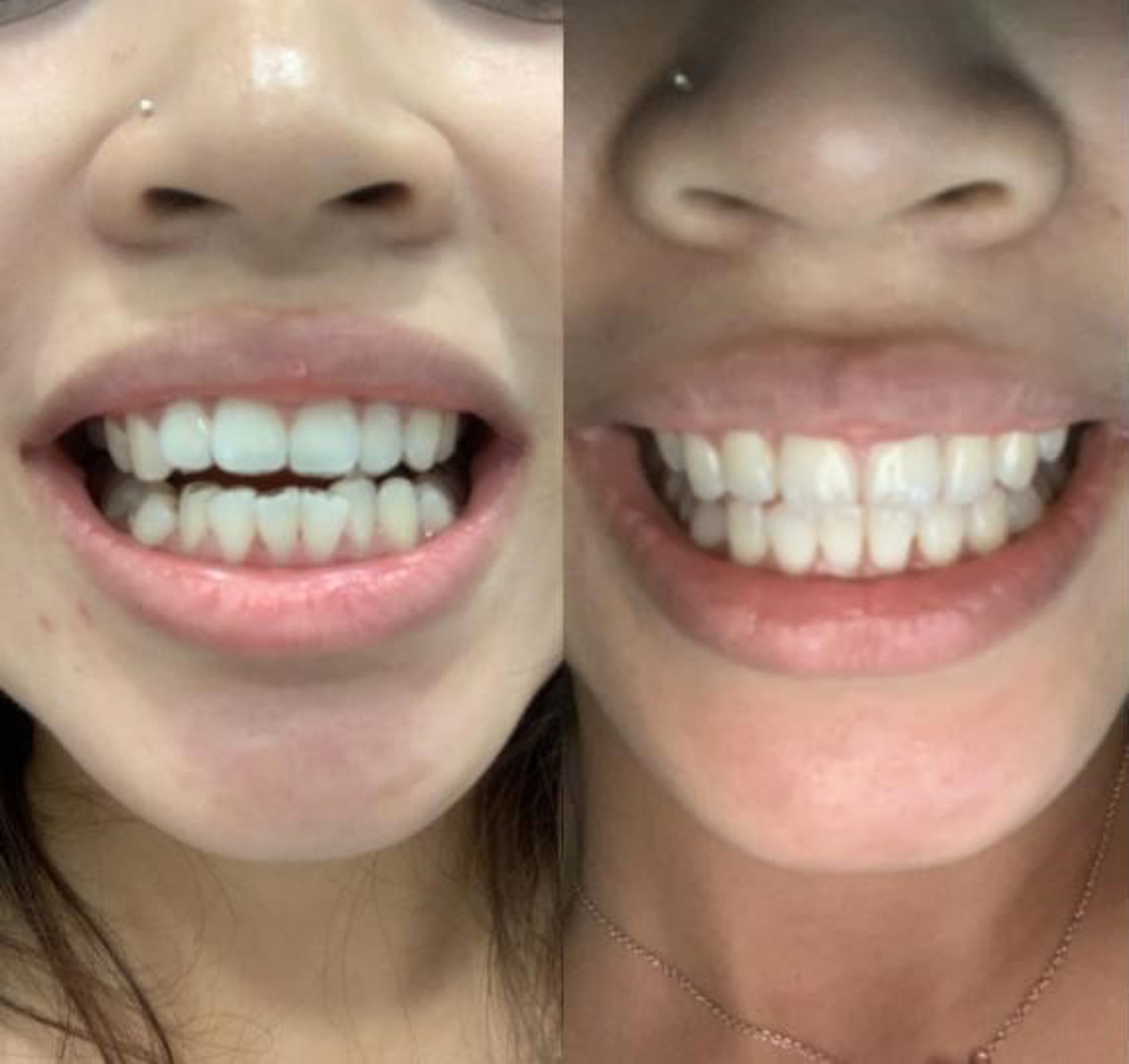 （圖左）細看Lorraine在箍牙前的下排牙齒，明顯不整齊；（右圖）而經過短短4個月時間，就已經回復整齊。（圖片：受訪者提供）