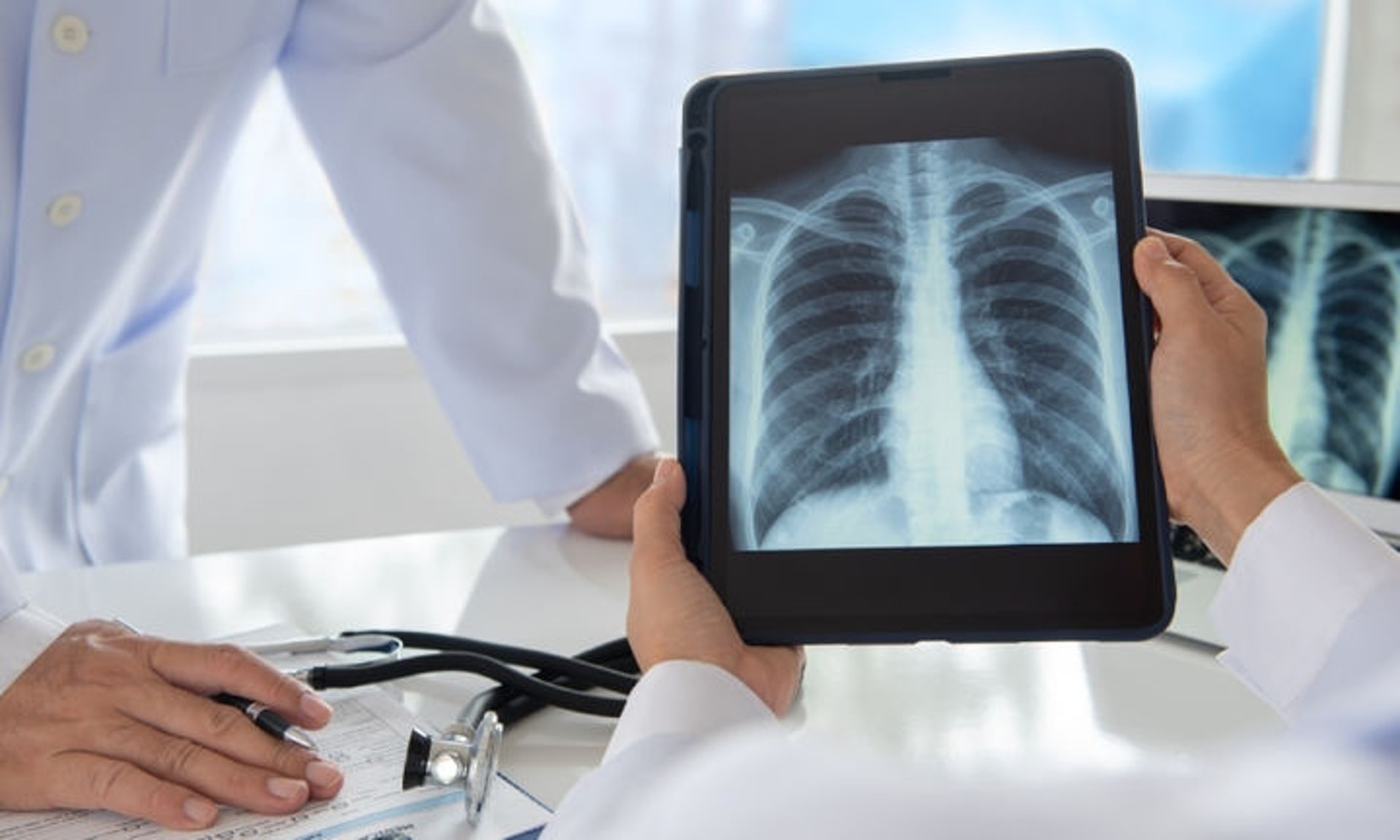 肺癆的檢測方法通常是照肺部 X 光，即使肺片無花，也未必代表外傭沒有患有肺結核。（圖片：Shutterstock）