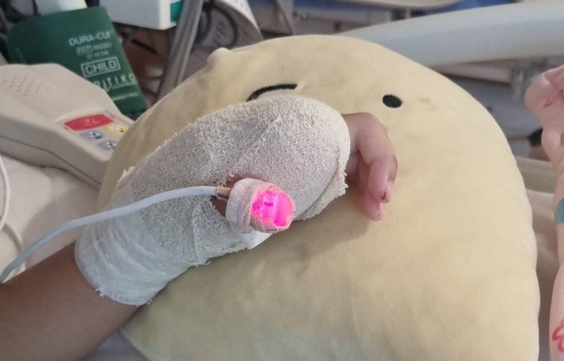 女童因為意外而失去一大截食指,更曾2度接受手術。 (網上圖片) 女童因為意外而失去一大截食指,更曾2度接受手術。 (網上圖片)