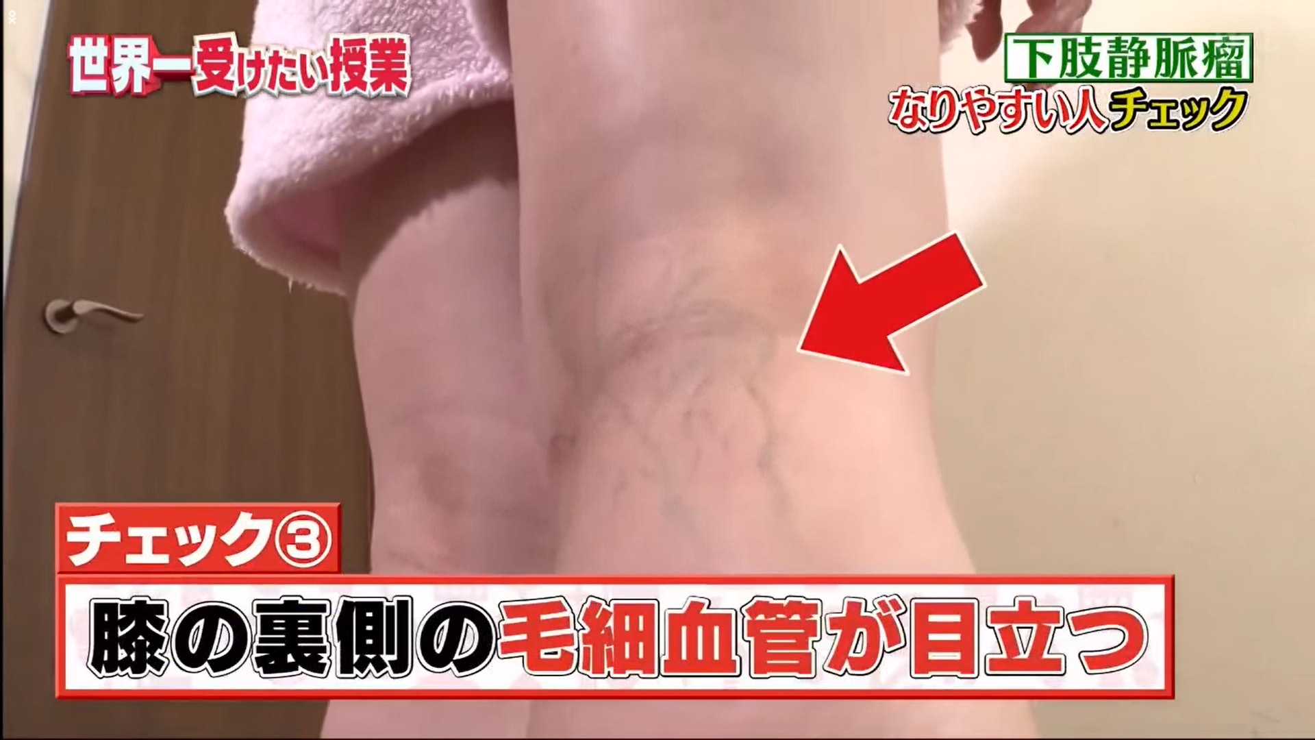 假如膝蓋後方的微絲血管很顯眼,那就有可能是較易患上靜脈曲張的人。(《世界一受けたい授業》截圖) 假如膝蓋後方的微絲血管很顯眼,那就有可能是較易患上靜脈曲張的人。(《世界一受けたい授業》截圖)