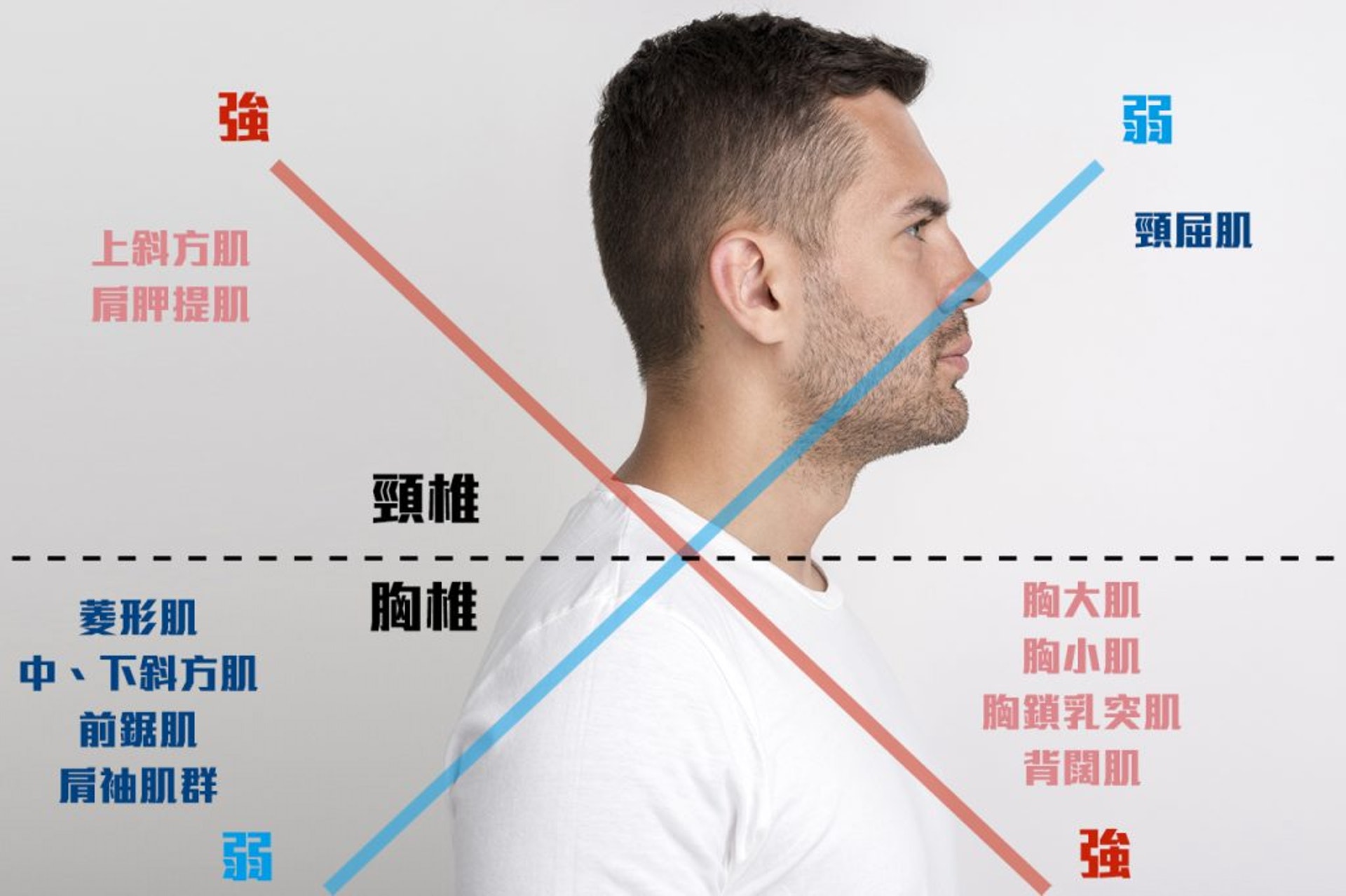 强肌肉群和弱肌肉群的張力會在頸背部相交,形成無形的交叉,因而稱為「上交叉綜合症」。(圖片:easthulk) 强肌肉群和弱肌肉群的張力會在頸背部相交,形成無形的交叉,因而稱為「上交叉綜合症」。(圖片:easthulk)