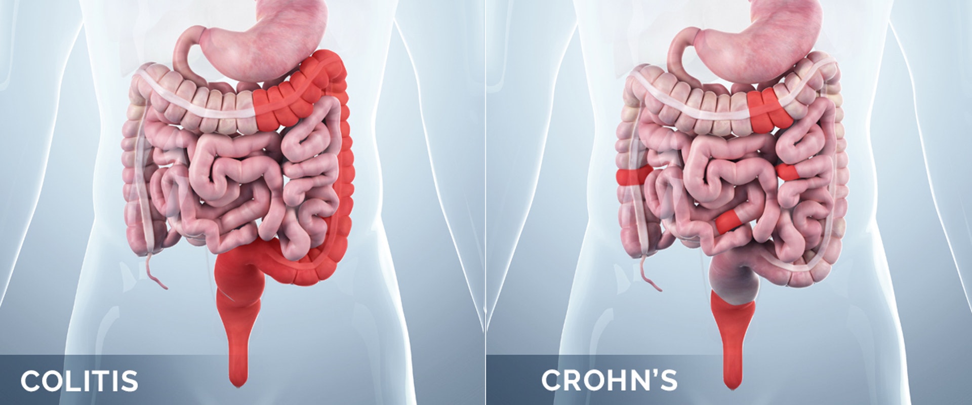 炎症性腸病可分為「潰瘍性結腸炎」和「克隆氏症」兩大類。前者（左圖）主要影響大腸黏膜；後者（右圖）除了會局部性影響大腸，亦有機會損害其他消化道器官組織。（圖片：healthmatters）