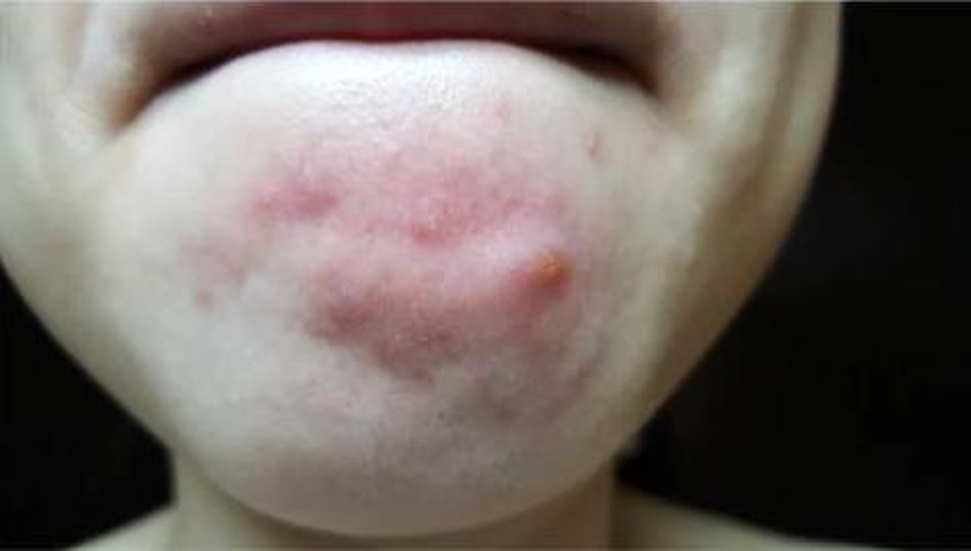 發炎位置更可能深入肌膚，變成又紅又腫的封閉式「石頭瘡」。（圖片：acnecure）
