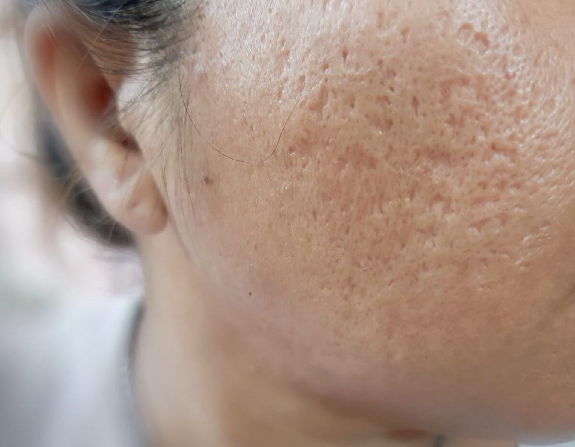 A酸常被處方用作治療如成人暗瘡等皮膚問題。(圖片:beauty-place) A酸常被處方用作治療如成人暗瘡等皮膚問題。(圖片:beauty-place)