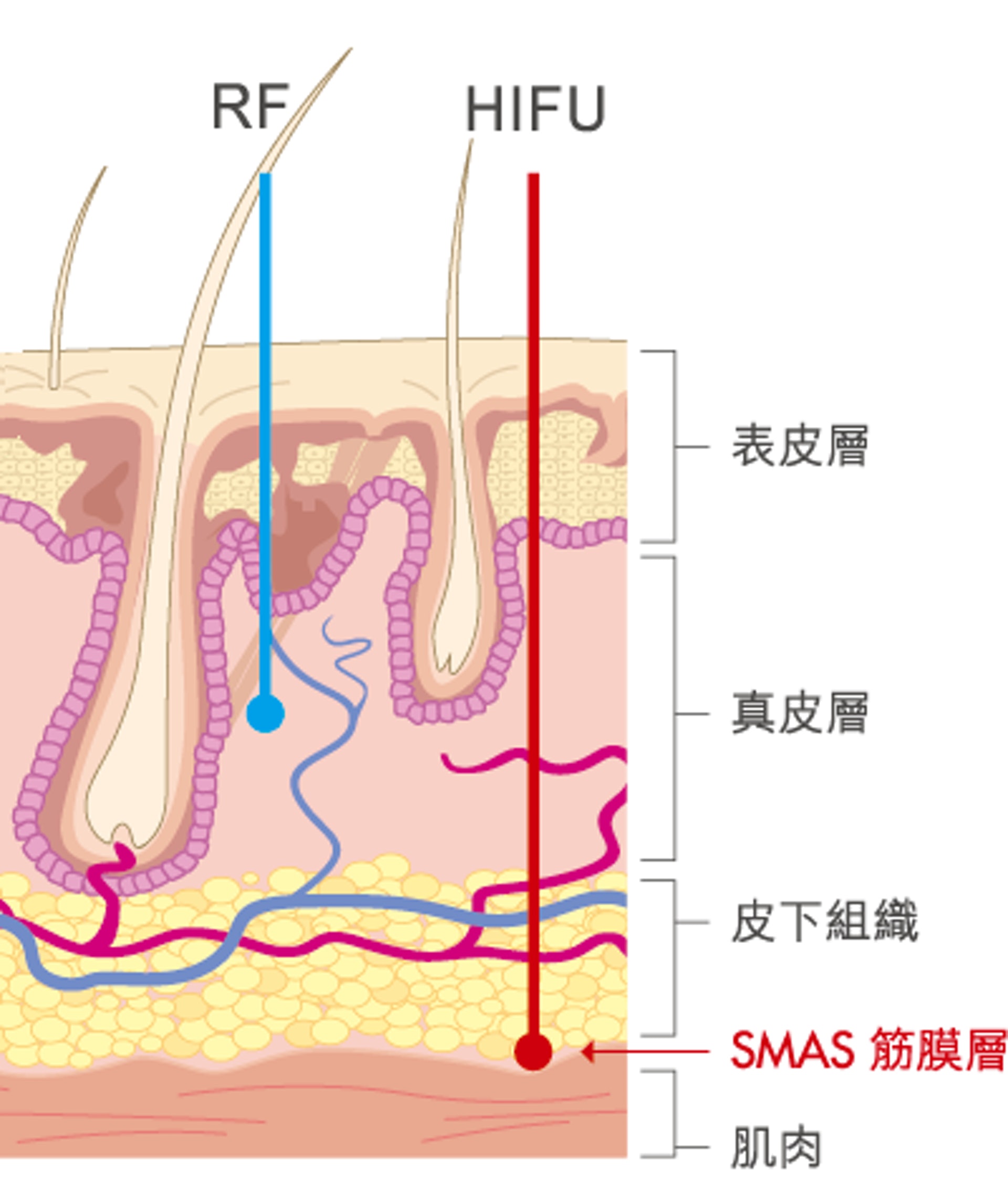 HIFU 能夠深入至 SMAS 筋膜層，即傳統拉皮手術針對處理的皮層，使 HIFU 具備 RF 所缺乏的 「提升」效果。(圖片：網絡圖片）