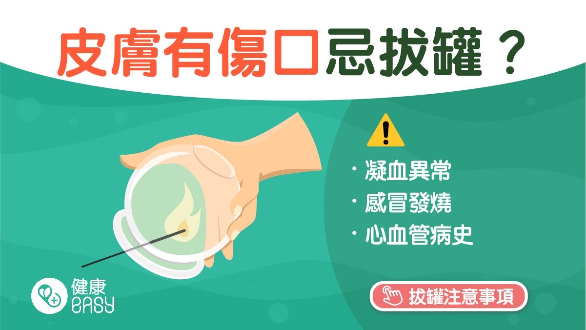 拔罐|有效促進血液循環、改善身體痠痛 但有五類人要避免拔罐? 拔罐|有效促進血液循環、改善身體痠痛 但有五類人要避免拔罐?