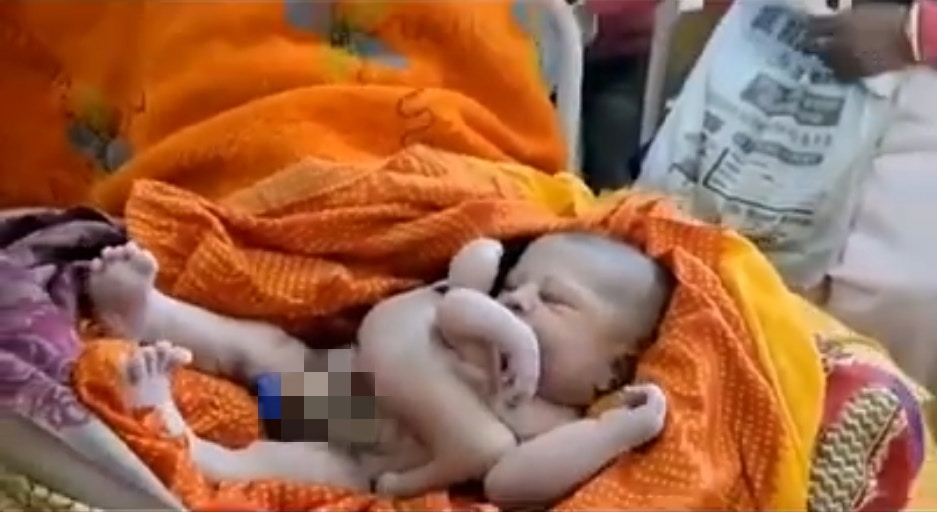 印度东部在17日诞生一名特别的婴儿，刚出生的他拥有4只手臂和4只脚，其中有一只脚还是长在头和腹部之间。（影片截图：Josh@doomdaammuchatlu）