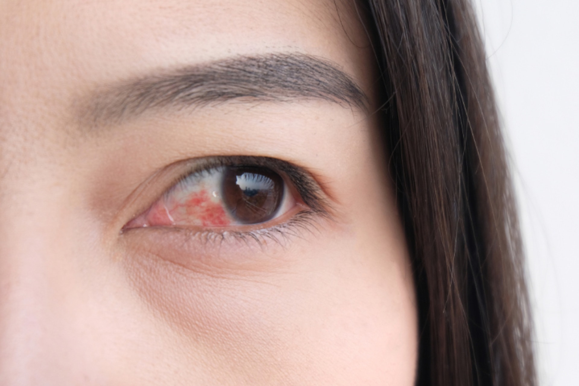 糖尿病伴隨各種慢性併發症，其中俗稱「糖尿眼」的「糖尿病性視網膜病變」更會引致失明，是香港第二號致盲殺手。（圖片：Shutterstock）