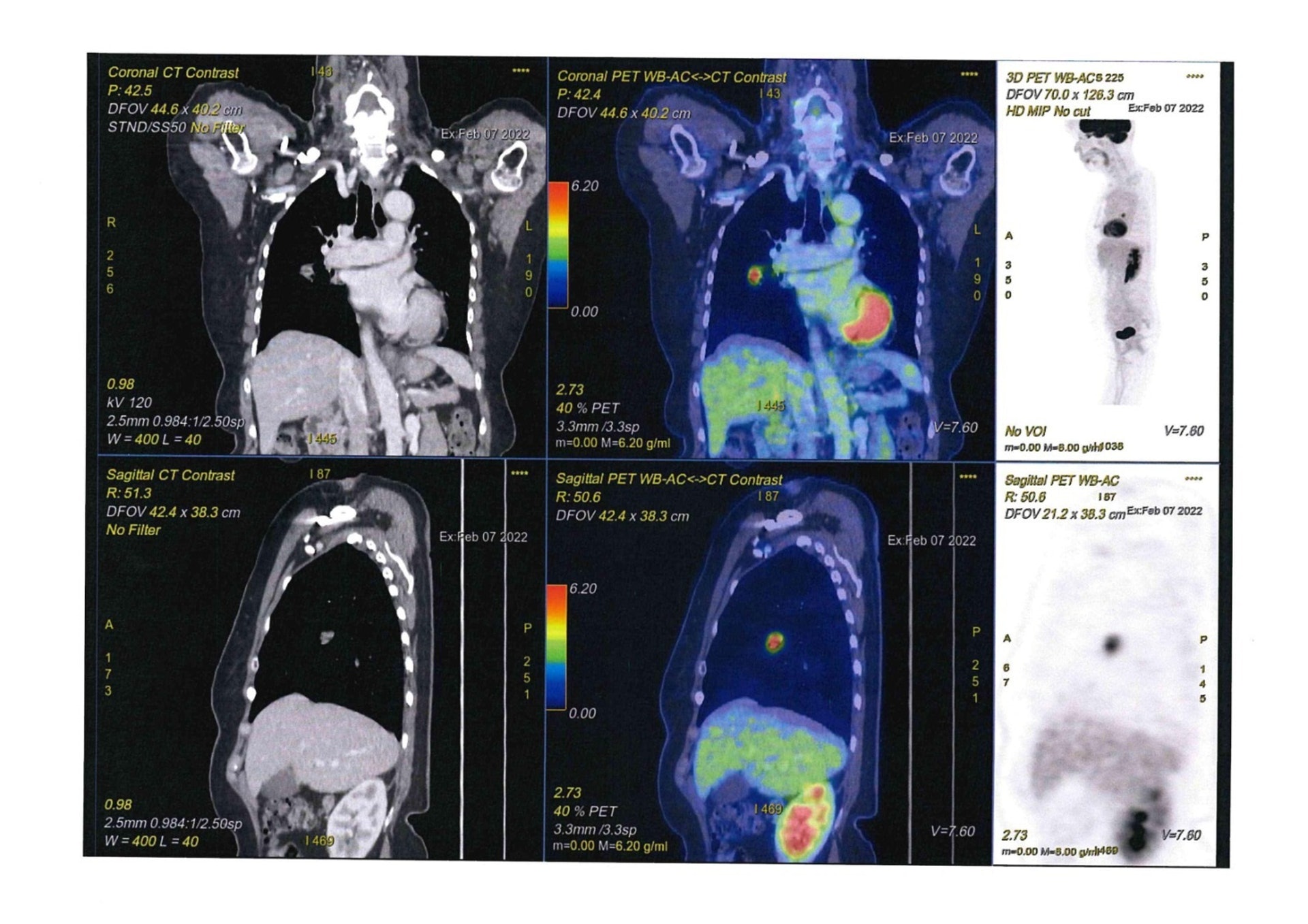 PET-CT可製造高清影像，並收集體內的輻射衰減數據，從而構成精確的影像，有助醫生得出準確的病變位置，例如圖中黑點便是腫瘤位置。（圖片：受訪者提供）