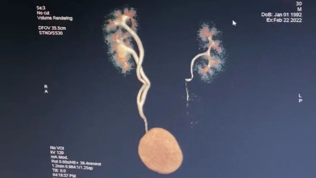 醫聊健康|河南漢體內竟有3個腎 原來是常見病且會遺傳下一代? 醫聊健康|河南漢體內竟有3個腎 原來是常見病且會遺傳下一代?