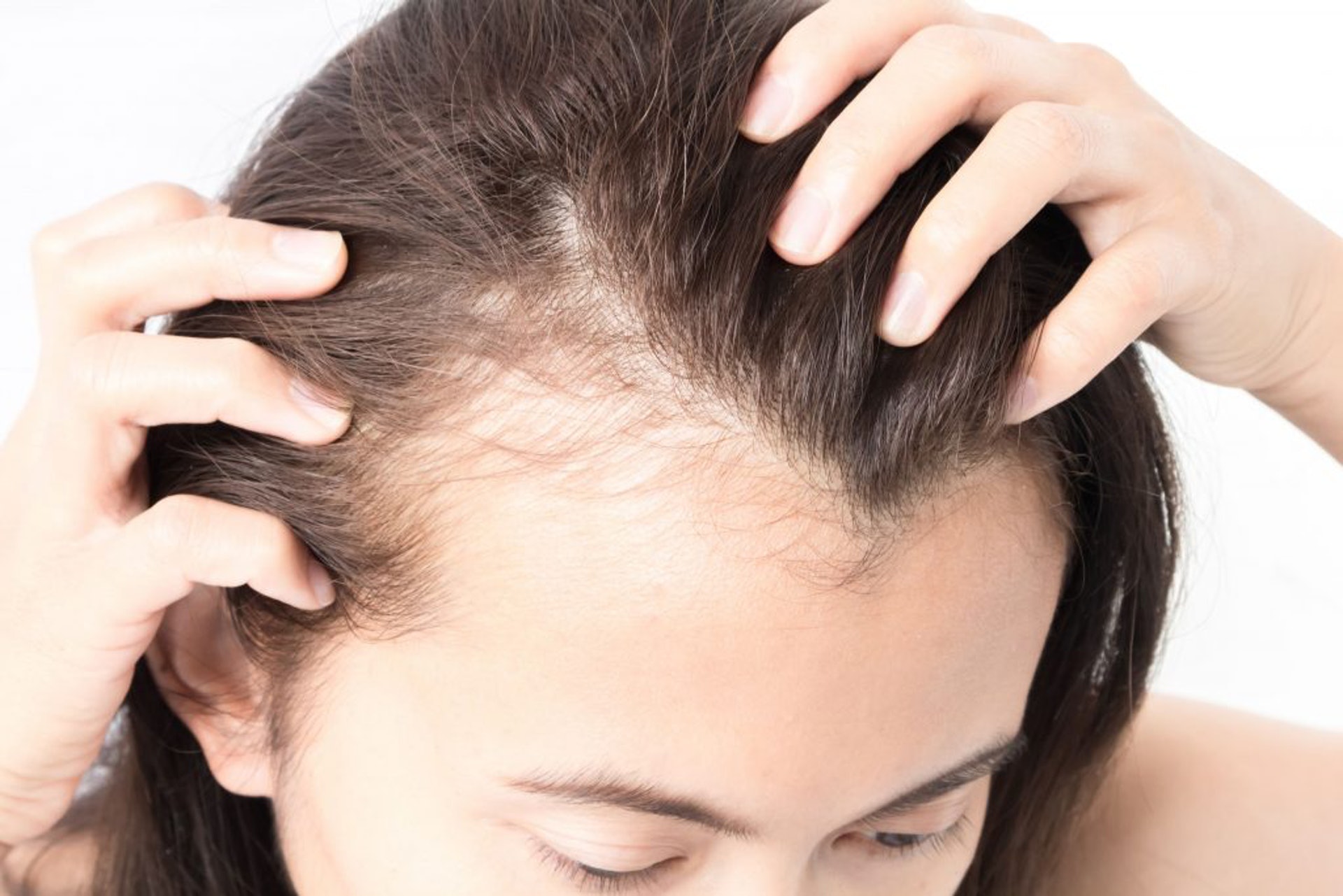 對於脫髮，中醫會透過觀察患者的不同臨床表現，辨別出誘發脫髮的病因再作治療。（圖片：Shutterstock）