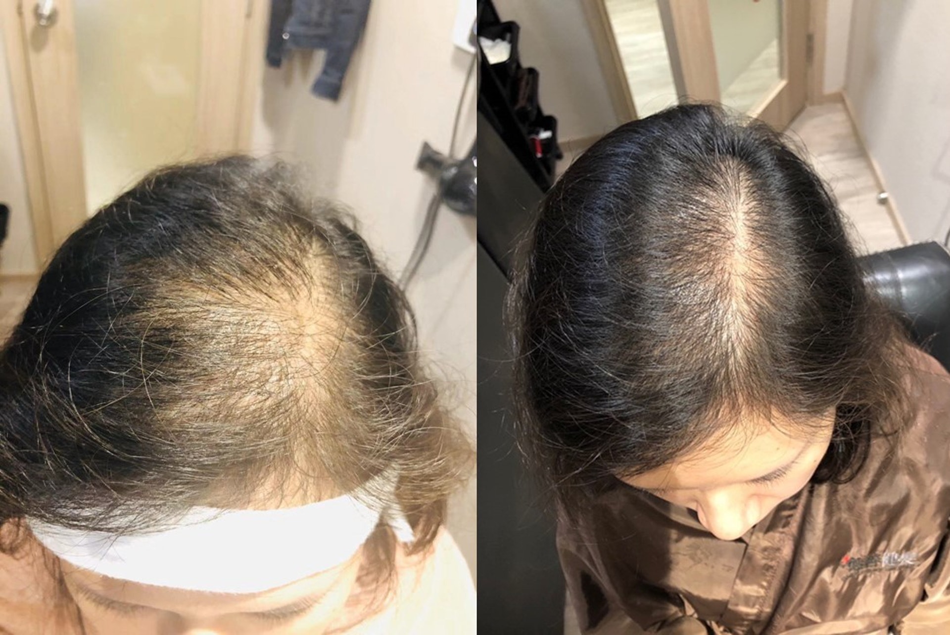 (左圖)李小姐長年飽受脫髪及不孕問題困擾,經中醫診症後,判斷她患有多囊性卵巢症。(右圖)經過約半年的治療後,脫髮問題已明顯改善,更完全治癒多囊性卵巢症,成功懷孕。(圖片:受訪者提供) (左圖)李小姐長年飽受脫髪及不孕問題困擾,經中醫診症後,判斷她患有多囊性卵巢症。(右圖)經過約半年的治療後,脫髮問題已明顯改善,更完全治癒多囊性卵巢症,成功懷孕。(圖片:受訪者提供)