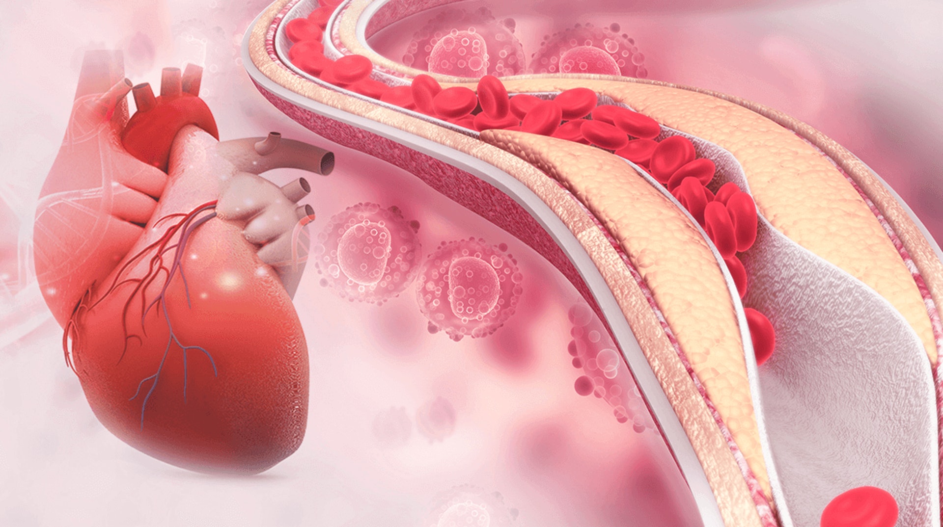 冠狀動脈出現栓塞情況會導致心臟得不到足夠血液，引發冠心病，而心臟細胞亦會在這個過程中壞死。（圖片：網上圖片）