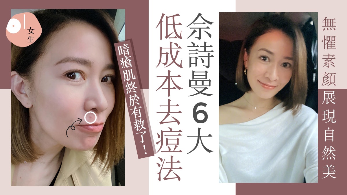 暗瘡|佘詩曼低成本去痘神器 成功治好暗瘡肌其中一種效果超顯著 暗瘡|佘詩曼低成本去痘神器 成功治好暗瘡肌其中一種效果超顯著