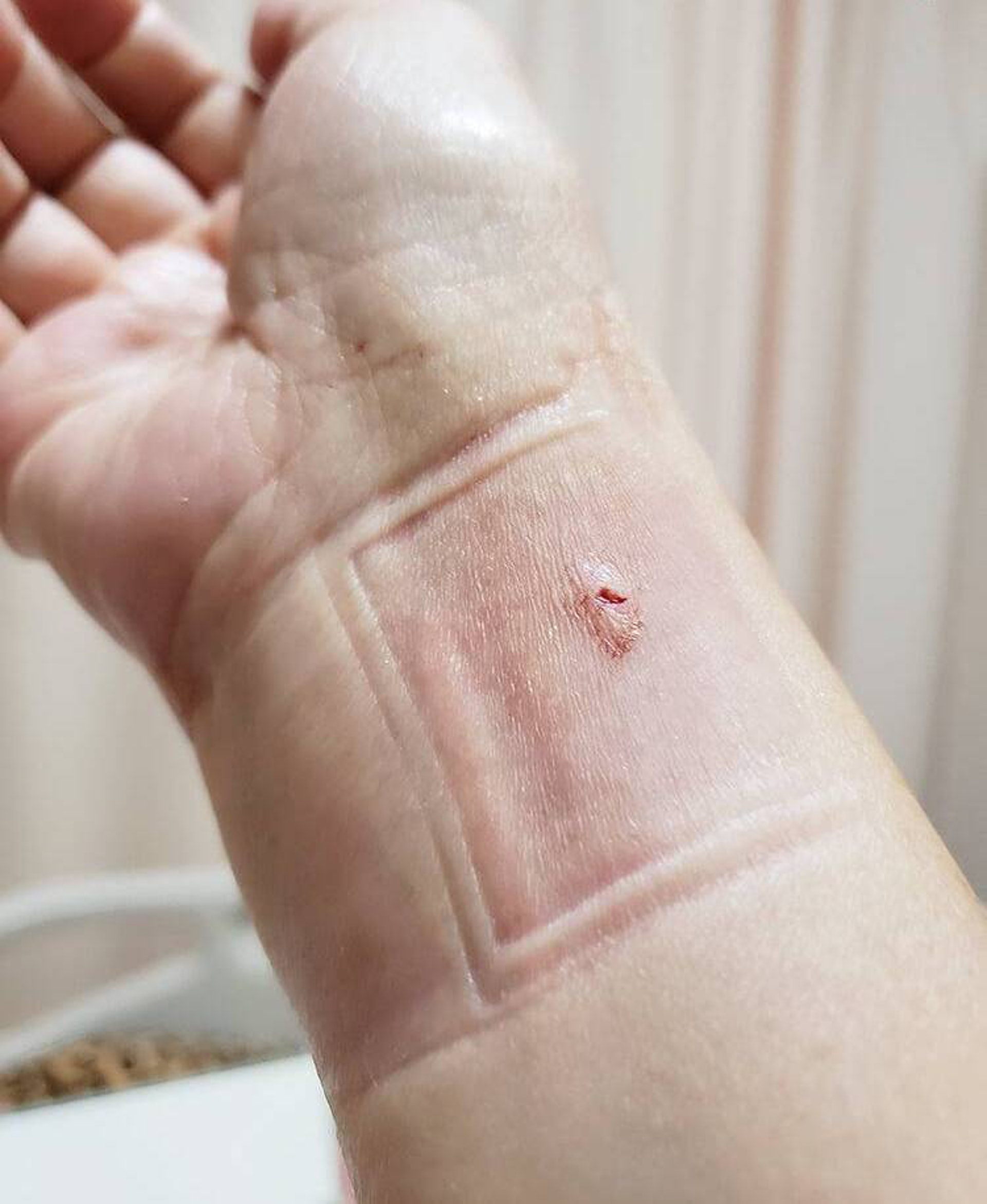手術傷口在手腕處，非常細。（圖片：受訪者提供）