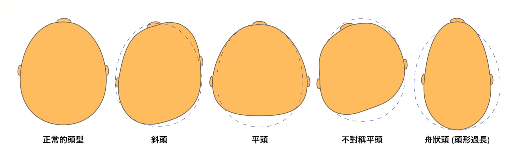 扁頭綜合症常見的類型（兒科醫生陳欣永提供）