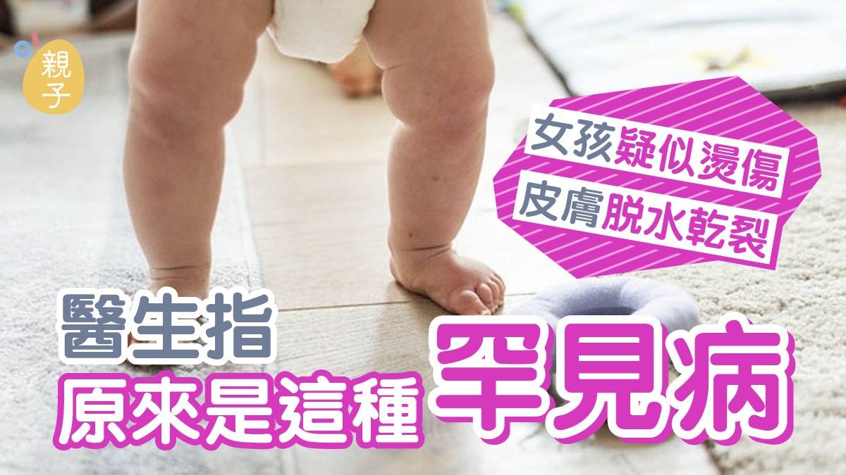 嬰兒健康｜女孩疑似燙傷　卻發高燒兼脫皮　醫生發現原來是這病