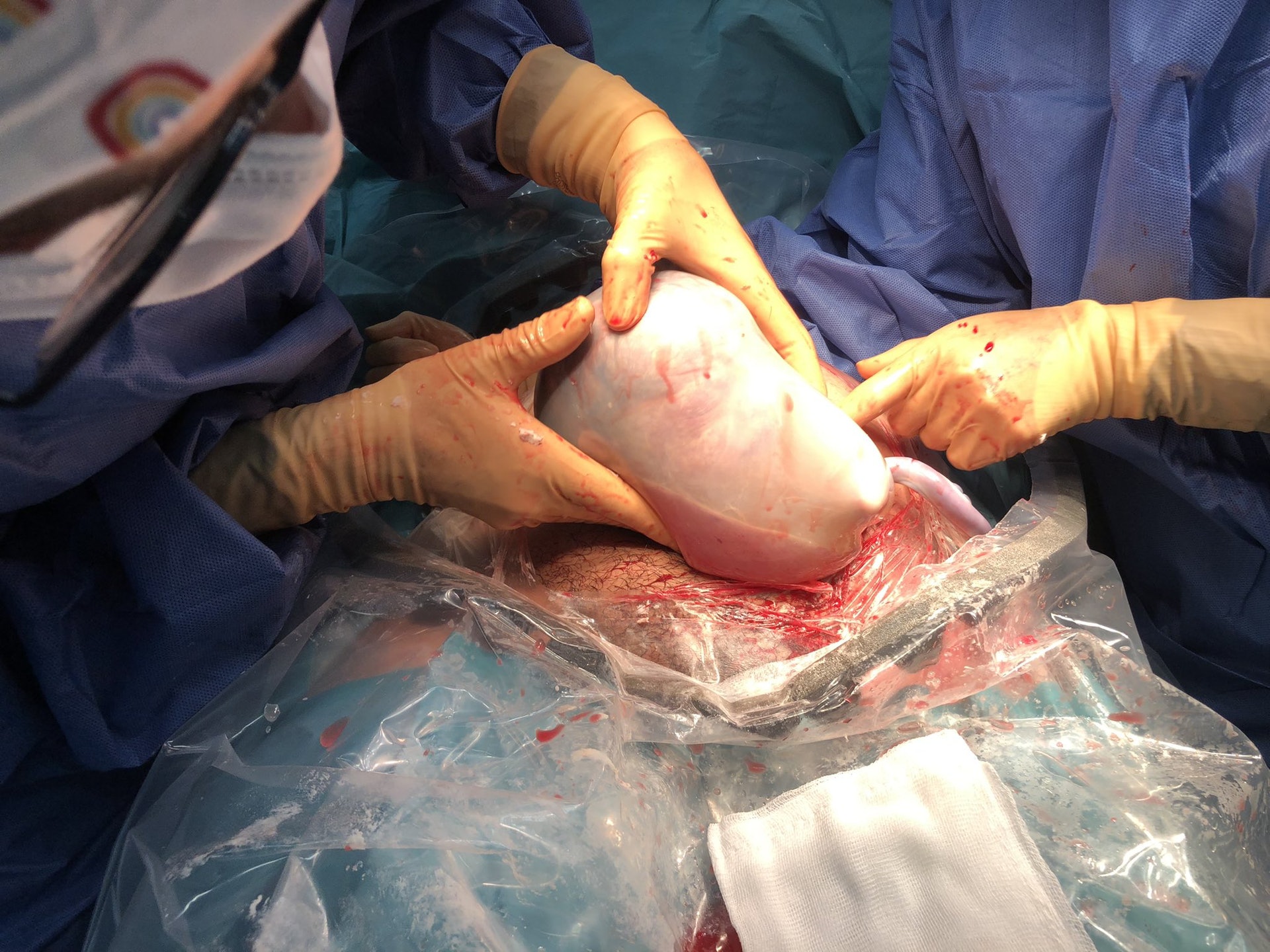 媽媽剖腹產出「人魚雙胞胎」。(Twitter / @AnaTeijelo) 媽媽剖腹產出「人魚雙胞胎」。(Twitter / @AnaTeijelo)