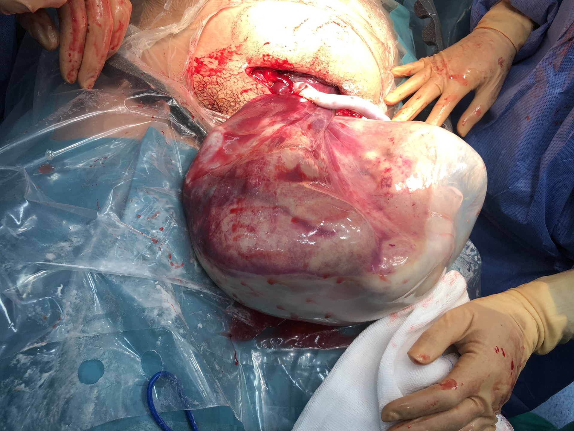 媽媽剖腹產出「人魚雙胞胎」。(Twitter / @AnaTeijelo) 媽媽剖腹產出「人魚雙胞胎」。(Twitter / @AnaTeijelo)