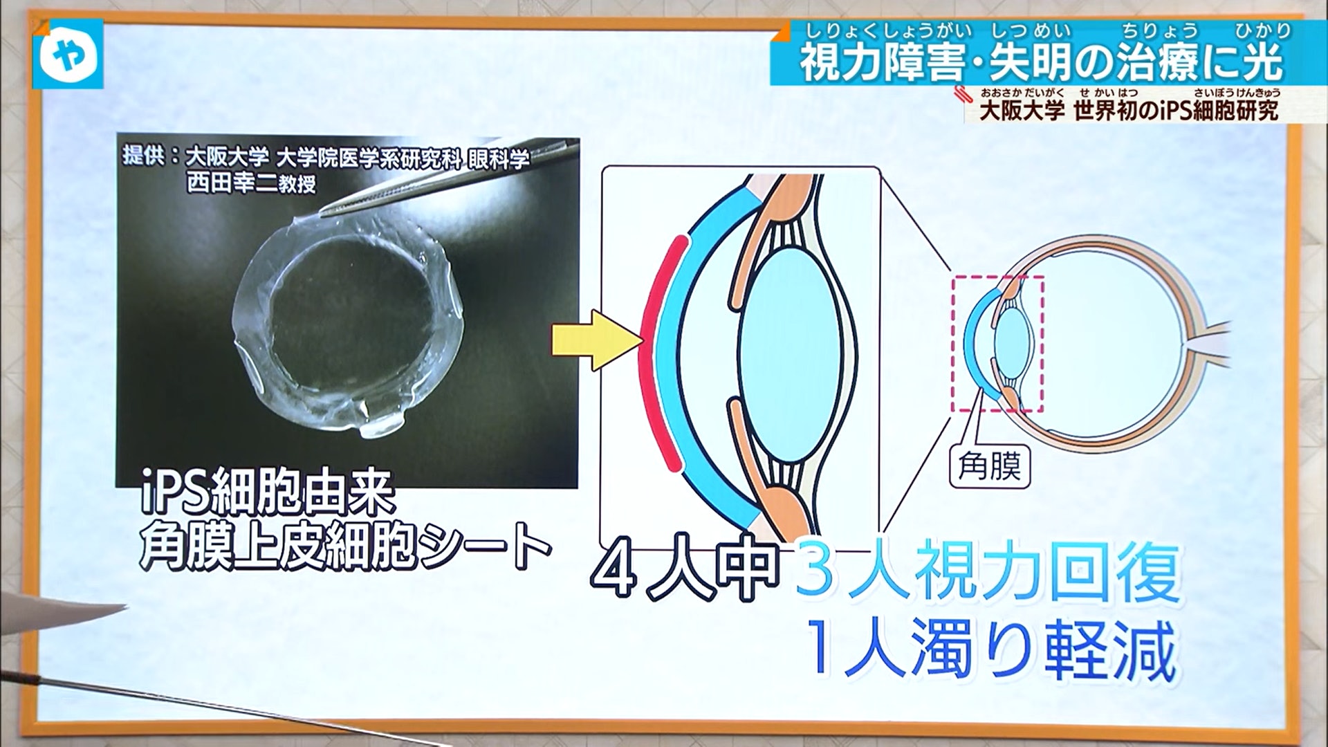 餘下1名病人其角膜混濁的情況亦得到改善，但由於視力檢查的結果飄忽，故未能下定論。（《テレビ大阪ニュース》）