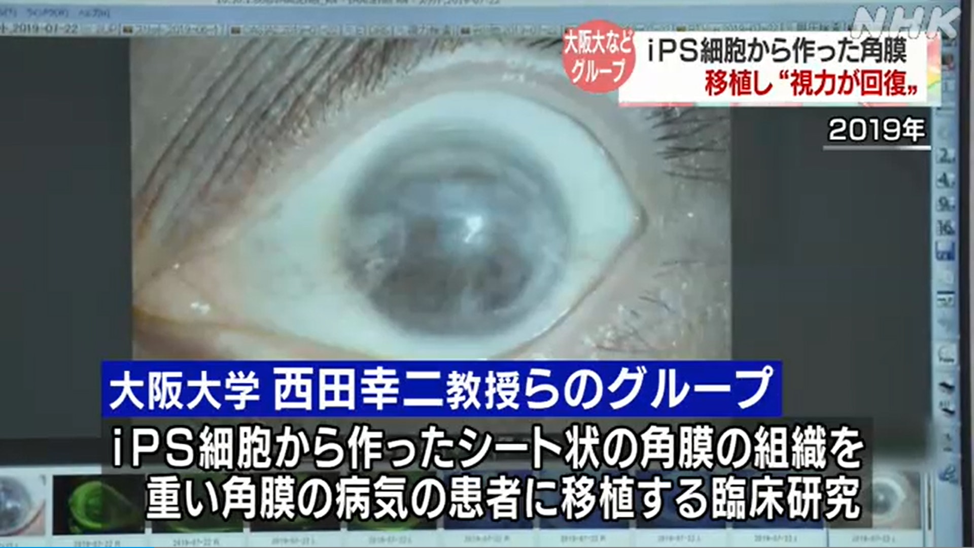 角膜上皮有可能基於受傷或疾病等原因無法更新,漸漸變得混濁,最終導致失明。(《NHK NEWS WEB》) 角膜上皮有可能基於受傷或疾病等原因無法更新,漸漸變得混濁,最終導致失明。(《NHK NEWS WEB》)