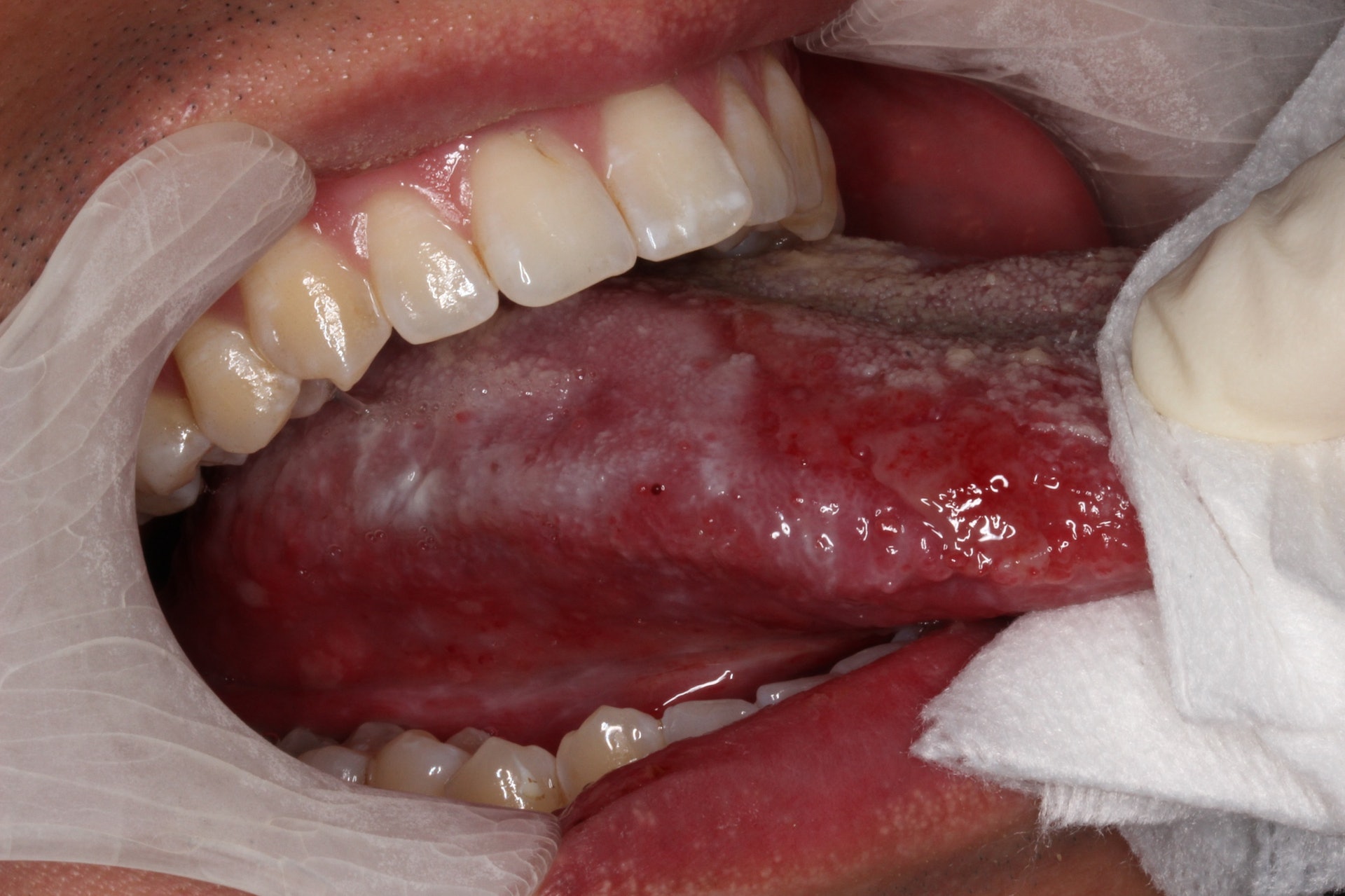 患有舌類扁平苔蘚黏膜炎的患者。（港大提供）