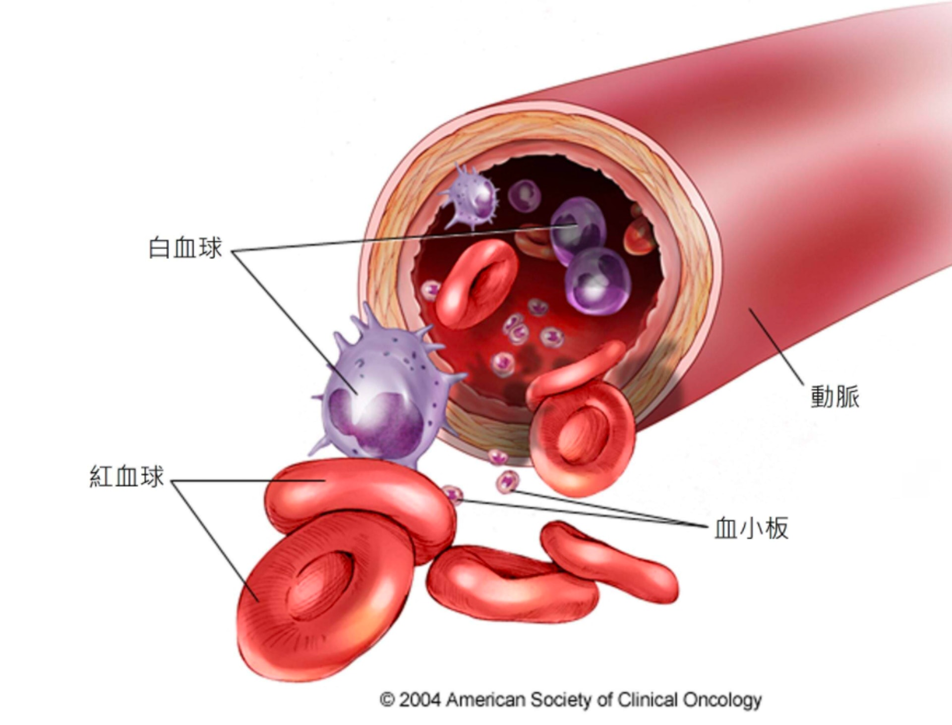 急性骨髓性白血病中，骨髓內會出現不正常的白血球、紅血球或血小板，這會令健康的白血球、紅血球和血小板減少，導致容易出現感染、貧血或出血症狀。(圖片來源：華人癌症資訊網 - 癌症圖說)