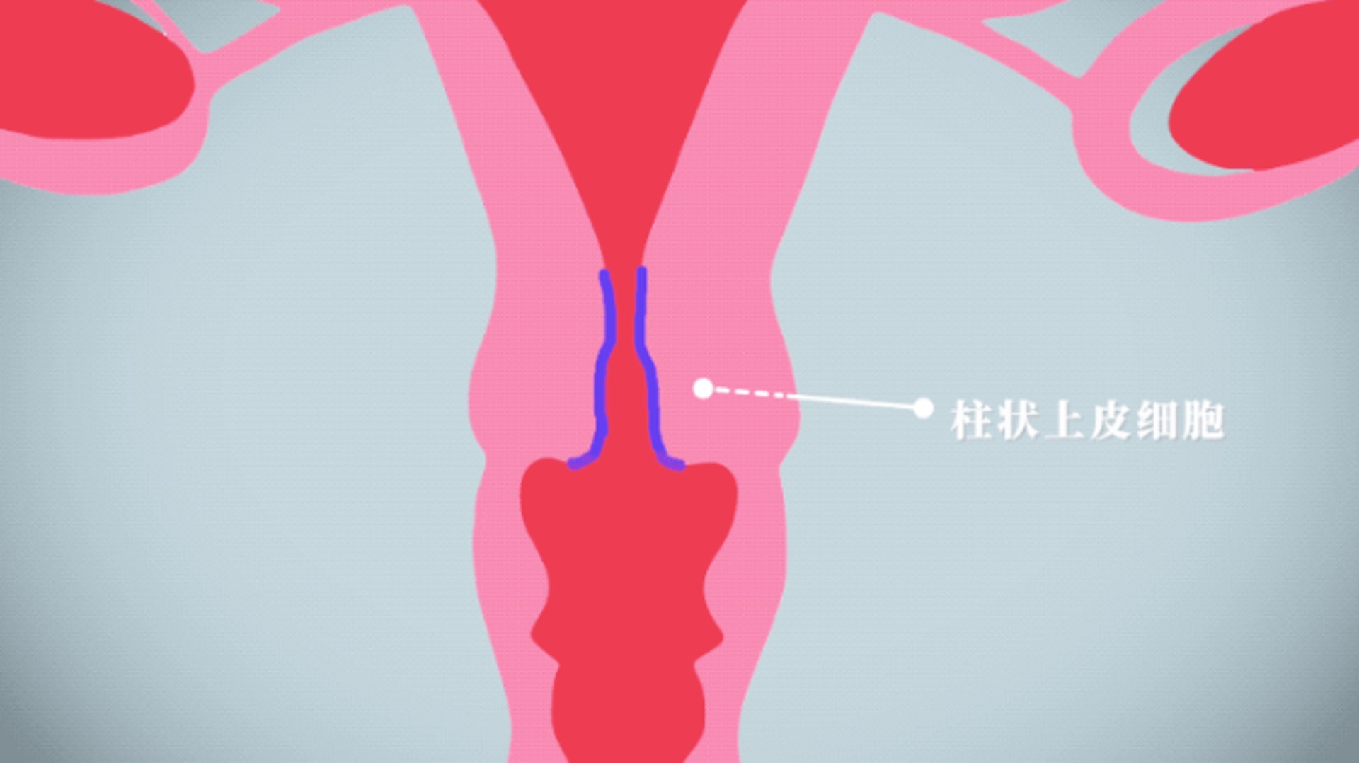 宮頸柱狀上皮的異位，是一種正常的生理現象。（一条）
