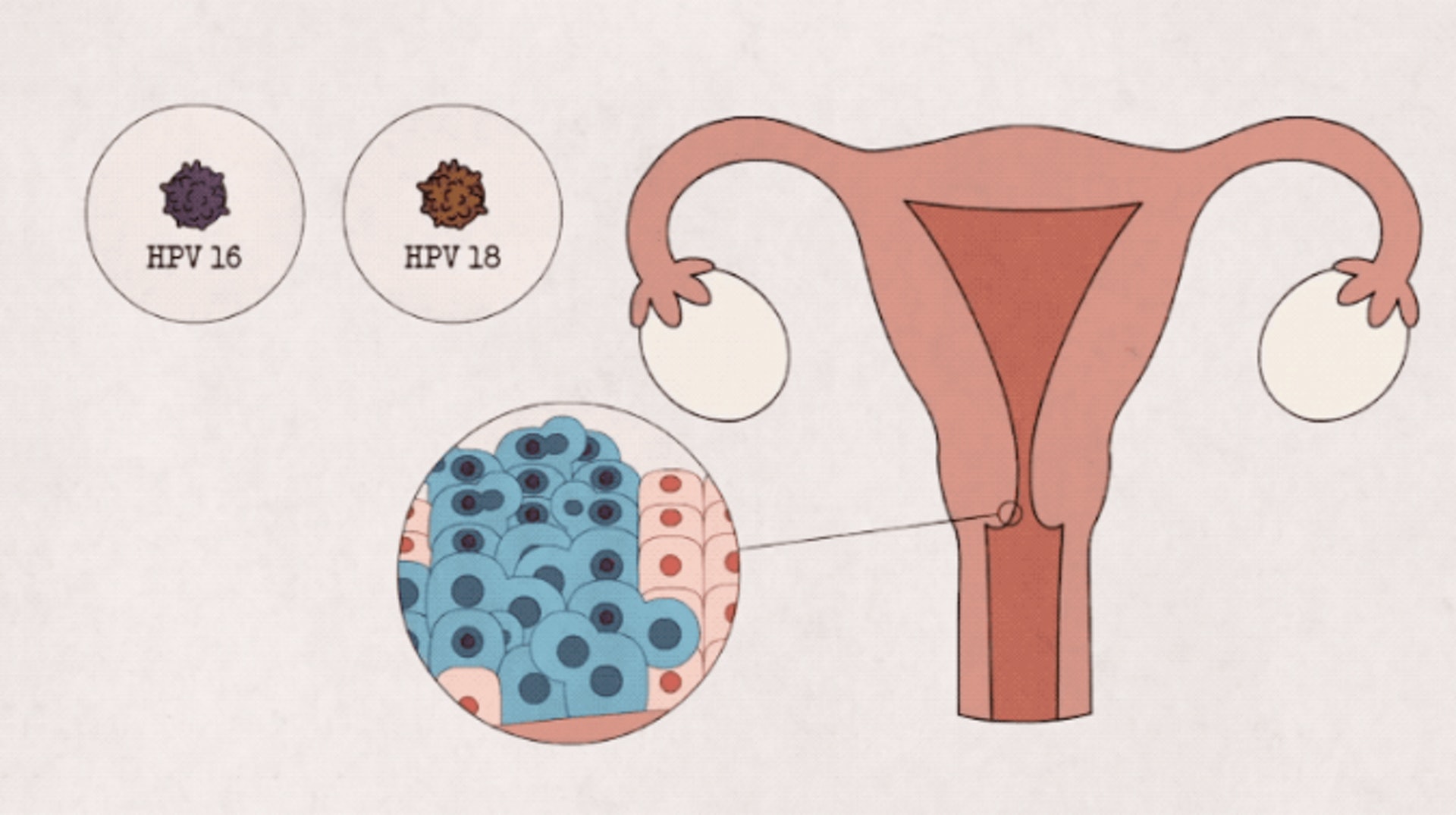 HPV人乳頭瘤病毒，70-80%的宮頸癌都與16和18兩個型別相關。（一条）