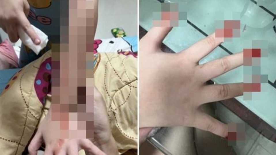 泰國女童打新冠疫苗後眼耳鼻及皮膚不停流血 未知是否與疫苗有關 泰國女童打新冠疫苗後眼耳鼻及皮膚不停流血 未知是否與疫苗有關