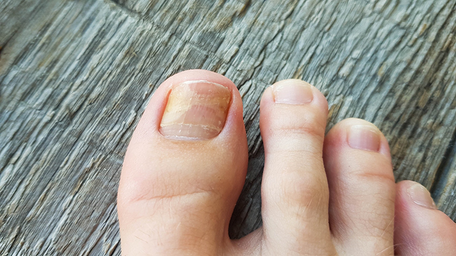 灰甲|眾所周知,香港天氣潮濕又悶熱容易滋生真菌,當皮膚受到感染隨時引發灰甲問題。(余俊亮 攝) 灰甲|眾所周知,香港天氣潮濕又悶熱容易滋生真菌,當皮膚受到感染隨時引發灰甲問題。(余俊亮 攝)