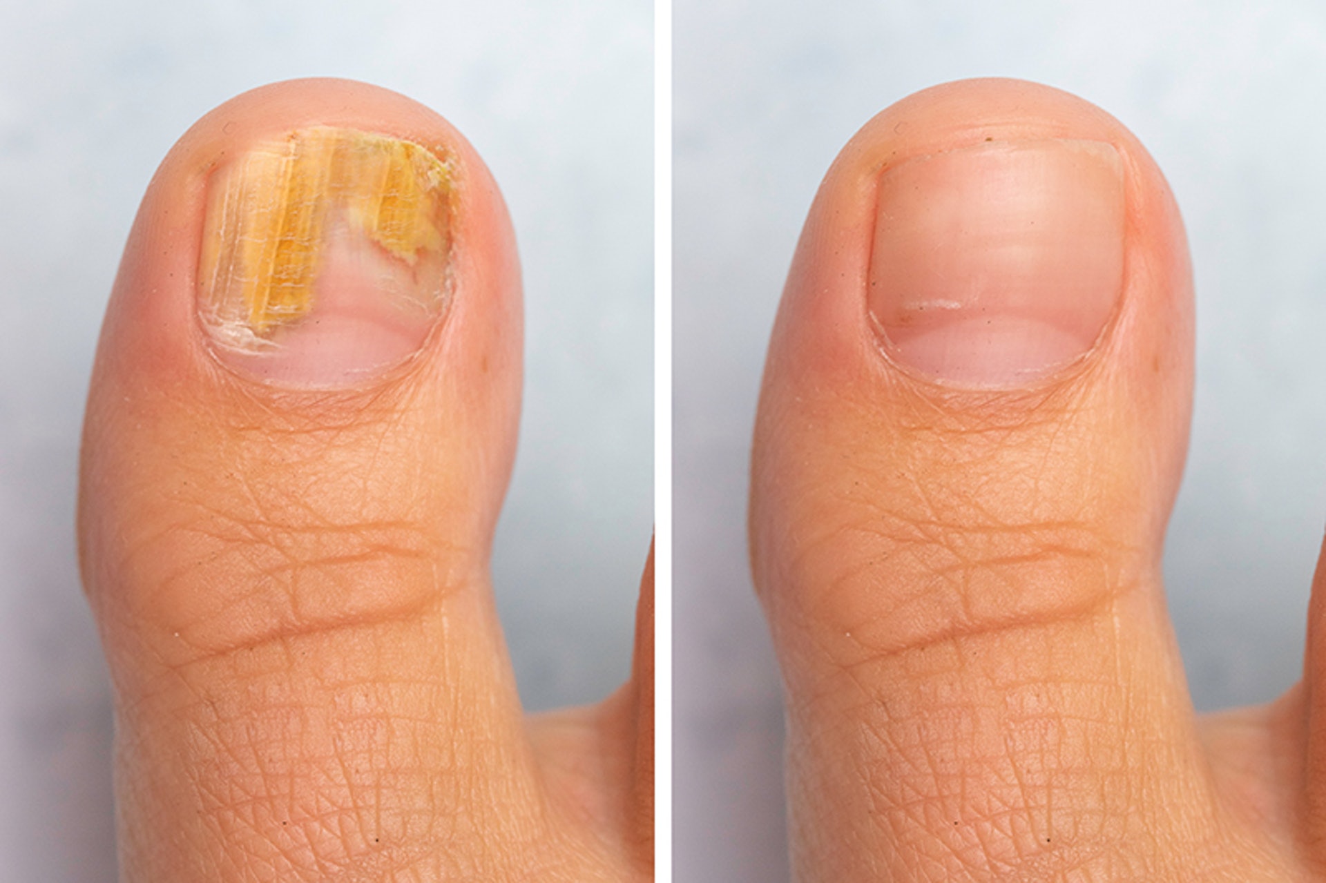 灰甲｜「黑指甲」形成除了運動外，指甲出現黑點的原因同樣與外傷關係密切，多數是撞傷或擠壓造成。的瘀血淤積（余俊亮 攝）