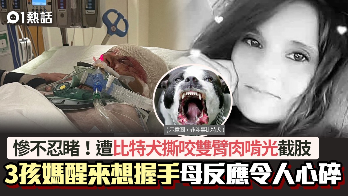 遭比特犬撕咬失雙臂3孩媽醒來崩潰 想握手 母反應令人心碎