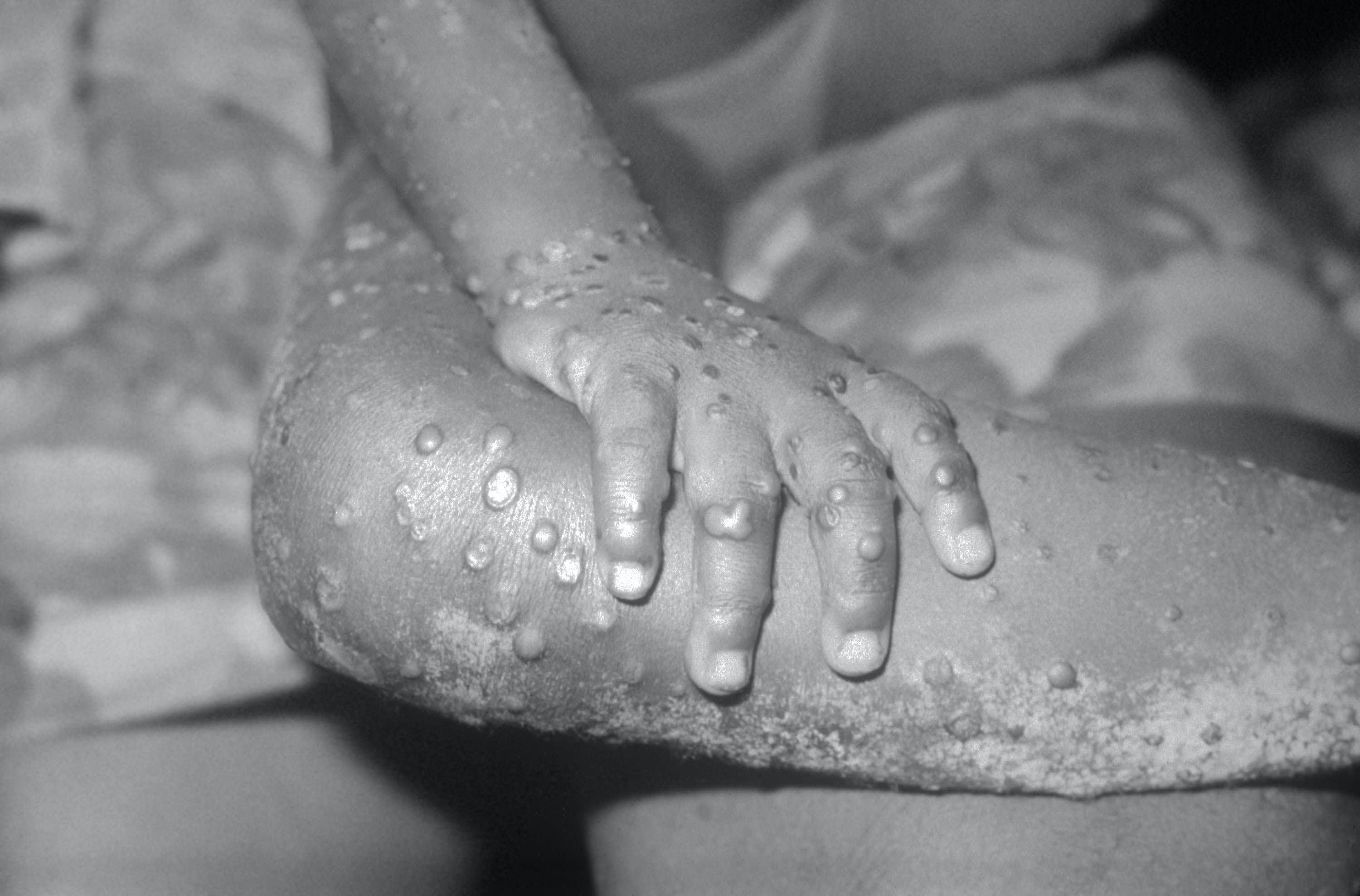 美国疾病控制和预防中心在1971年公布的照片，显示利比利亚一名女孩的手及腿部出现猴痘。（Getty Images）