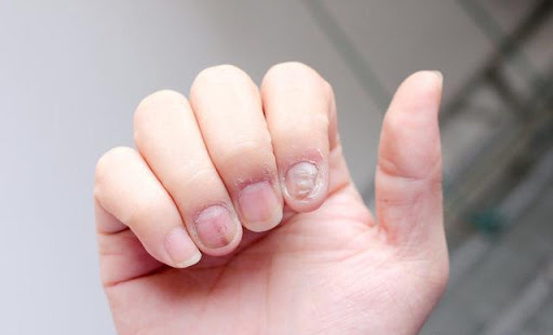 灰甲所引致的指甲變色、增厚甚至變形情況需要經過數個成長周期才能徹底消退，要指甲完全回復正常，難以單單依賴指甲自身的復原能力。（圖片：luxst）