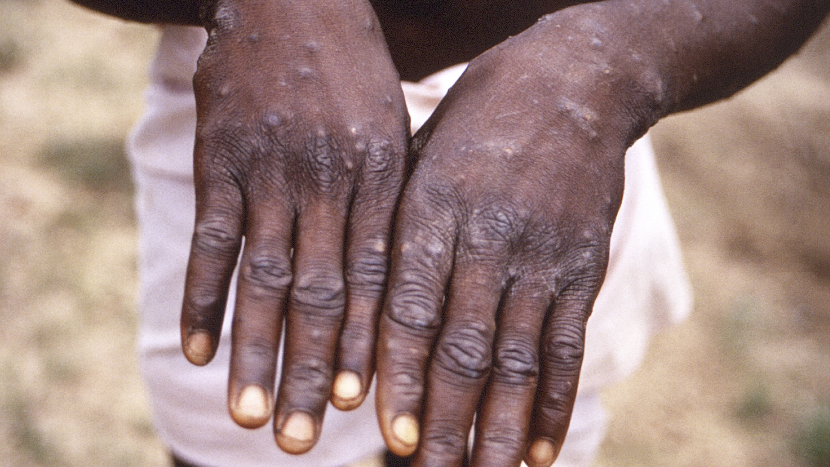 猴痘：图为美联社发布日期为2022年5月20日的照片，显示1997年刚果民主共和国一名猴痘病人的手部皮肤状况。（AP）