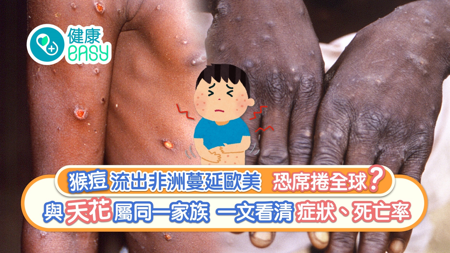 猴痘|流出非洲蔓延歐美恐席捲全球?與天花同家族 死亡率有幾高? 猴痘|流出非洲蔓延歐美恐席捲全球?與天花同家族 死亡率有幾高?