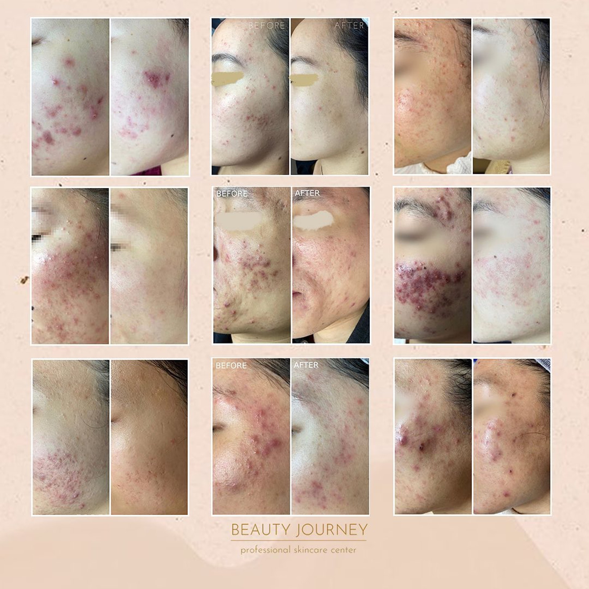 【針清推介美容院/針清黑頭】Beauty Journey預約經常爆滿,要提早預約,另有早鳥優惠。(beautyjourney2016@instagram) 【針清推介美容院/針清黑頭】Beauty Journey預約經常爆滿,要提早預約,另有早鳥優惠。(beautyjourney2016@instagram)