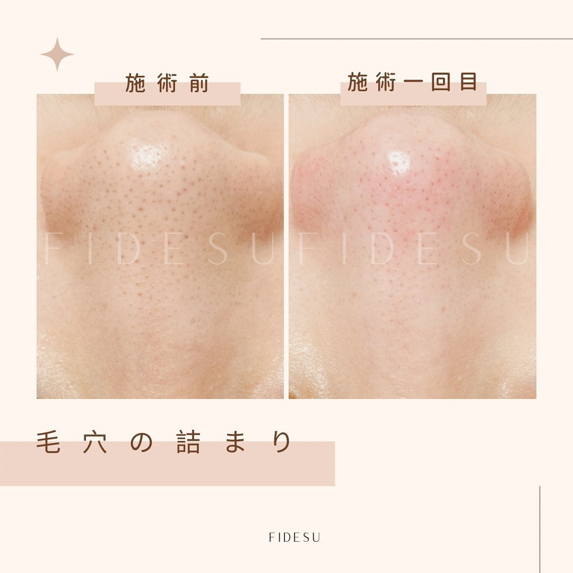【針清推介美容院/針清黑頭】FIDESU走日式風格。(fi_desu@instagram) 【針清推介美容院/針清黑頭】FIDESU走日式風格。(fi_desu@instagram)