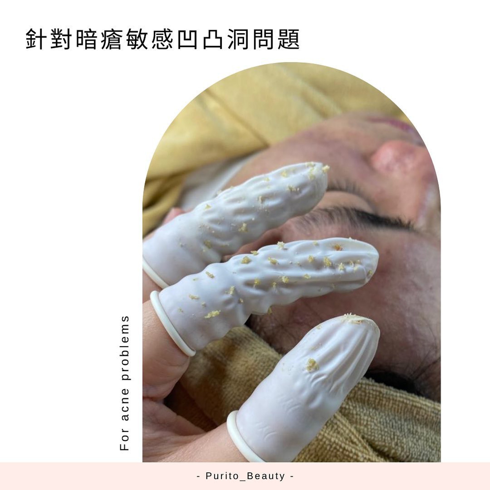 【針清推介美容院/針清黑頭】Purito會先了解客人肌膚狀況再決定療程。(purito_beauty@instagram) 【針清推介美容院/針清黑頭】Purito會先了解客人肌膚狀況再決定療程。(purito_beauty@instagram)