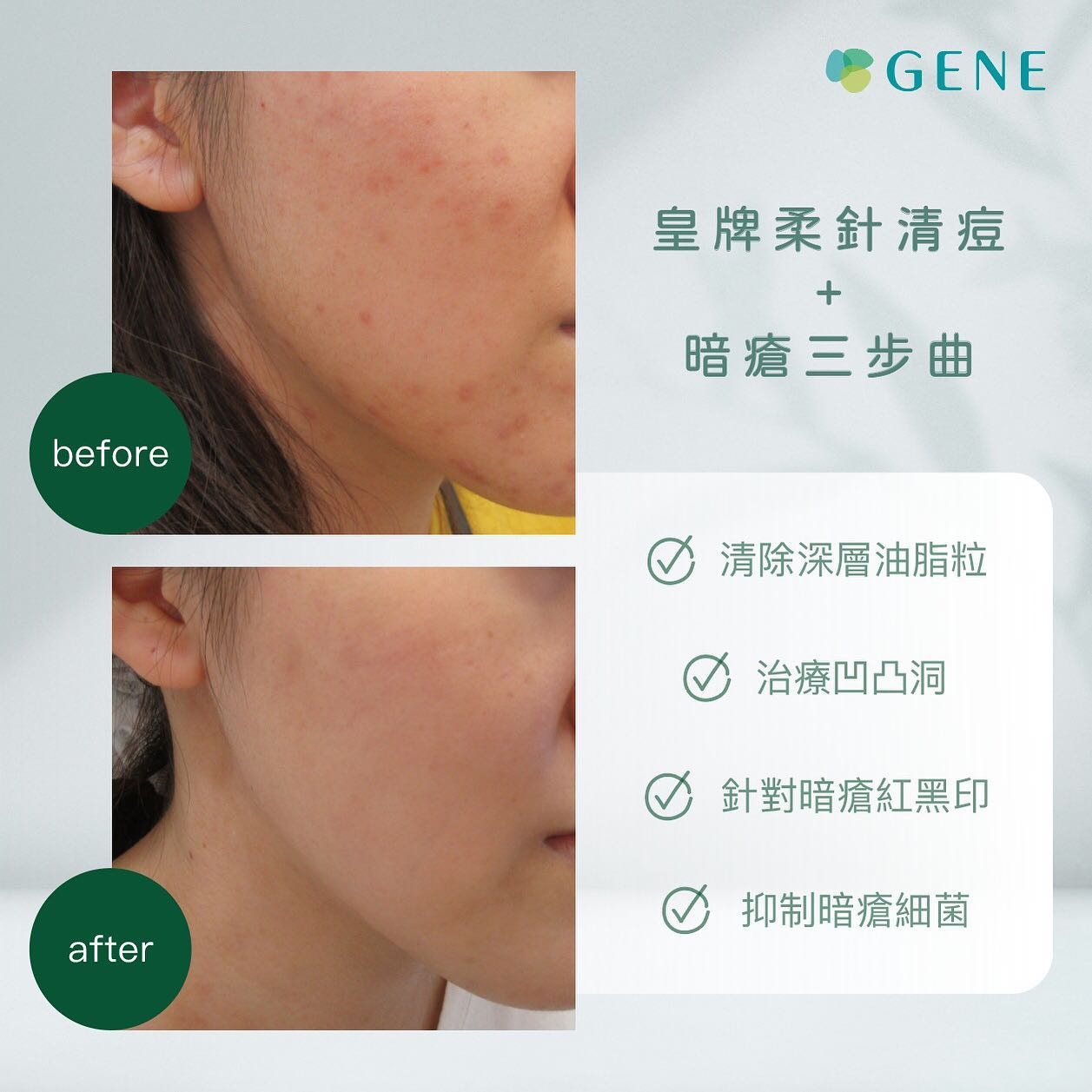 【針清推介美容院／針清黑頭】陳凱琳與雪姨都曾推介Gene。（geneskin.hk＠instagram）