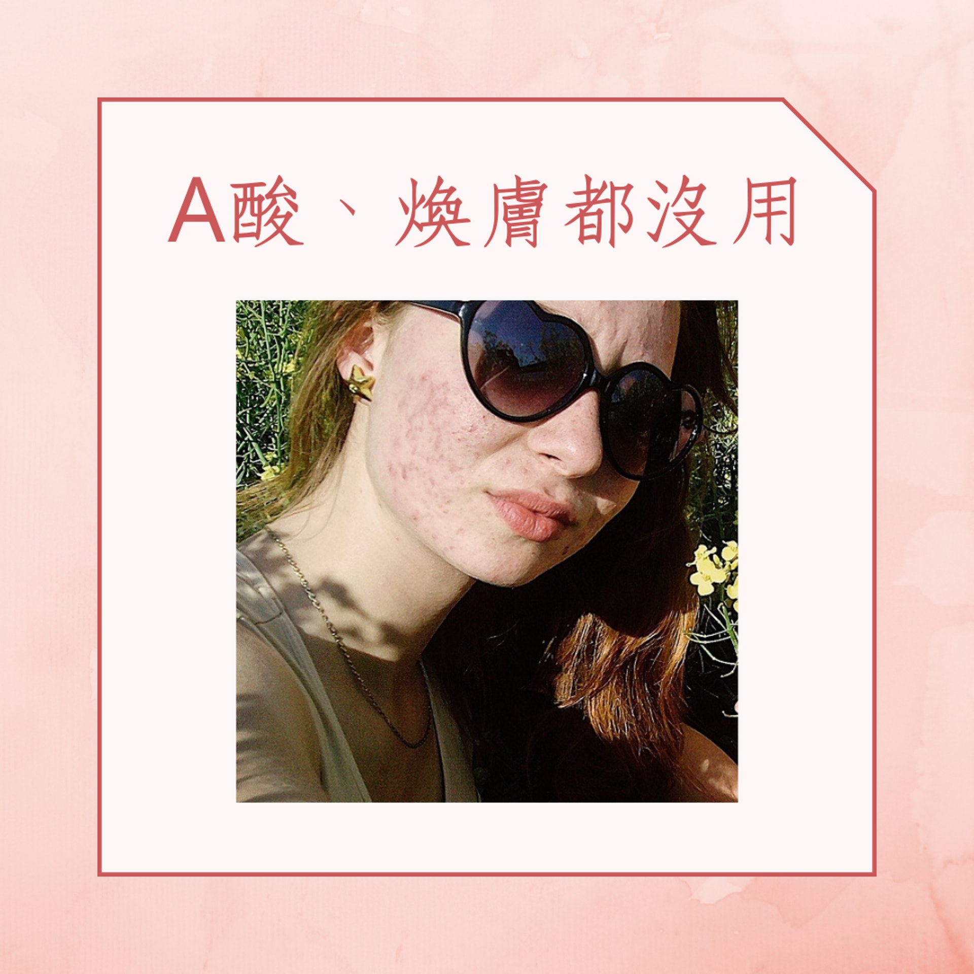3招醫好爛臉暗瘡(IG@muaivanak;01製圖) 3招醫好爛臉暗瘡(IG@muaivanak;01製圖)