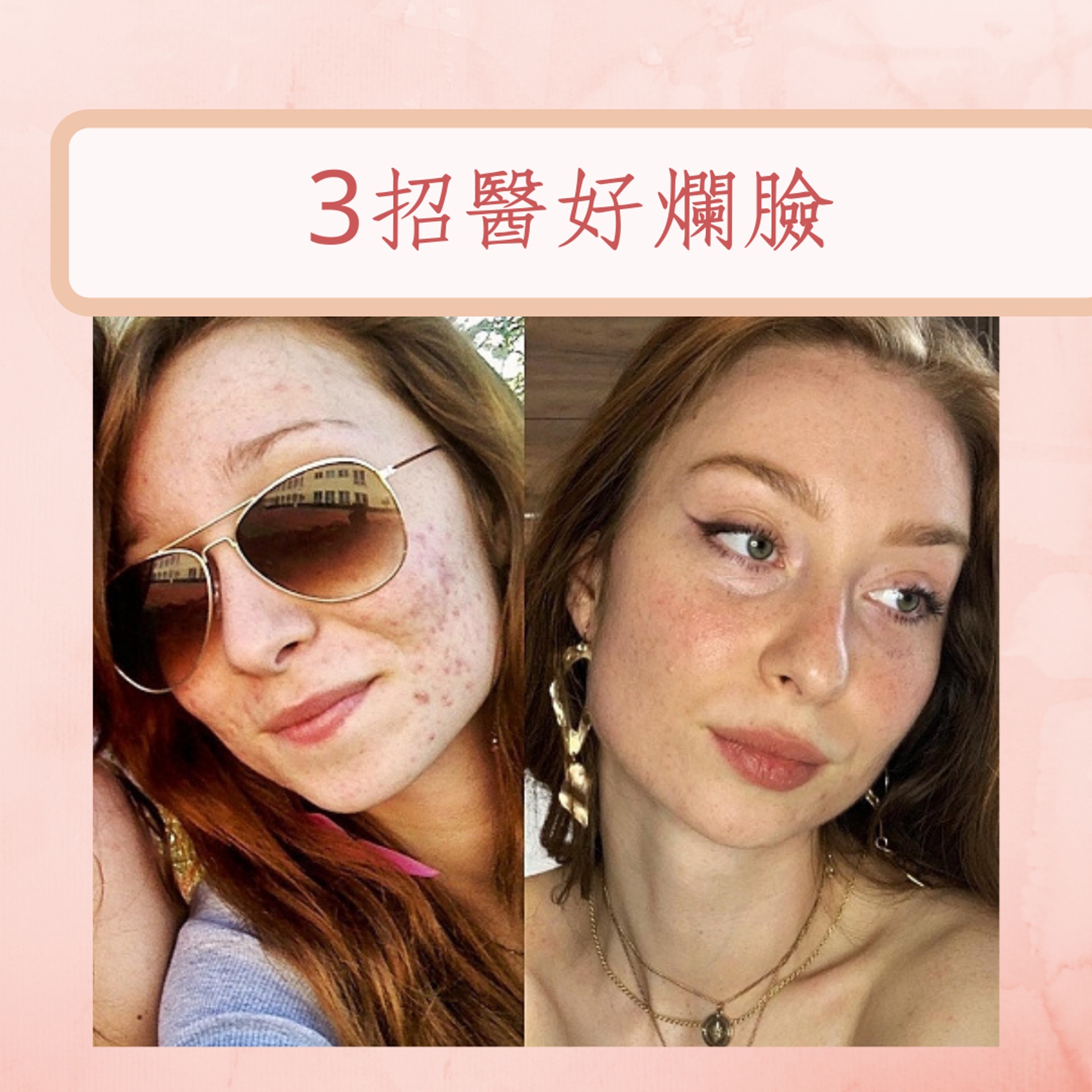 3招醫好爛臉暗瘡(IG@muaivanak;01製圖) 3招醫好爛臉暗瘡(IG@muaivanak;01製圖)