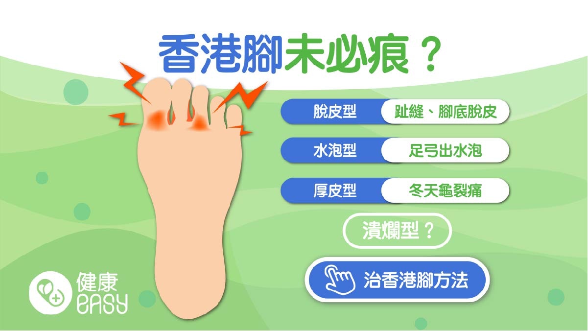 香港腳｜4大類型一次搞懂未必痕？3方法預防改善記謹保持腳部涼爽