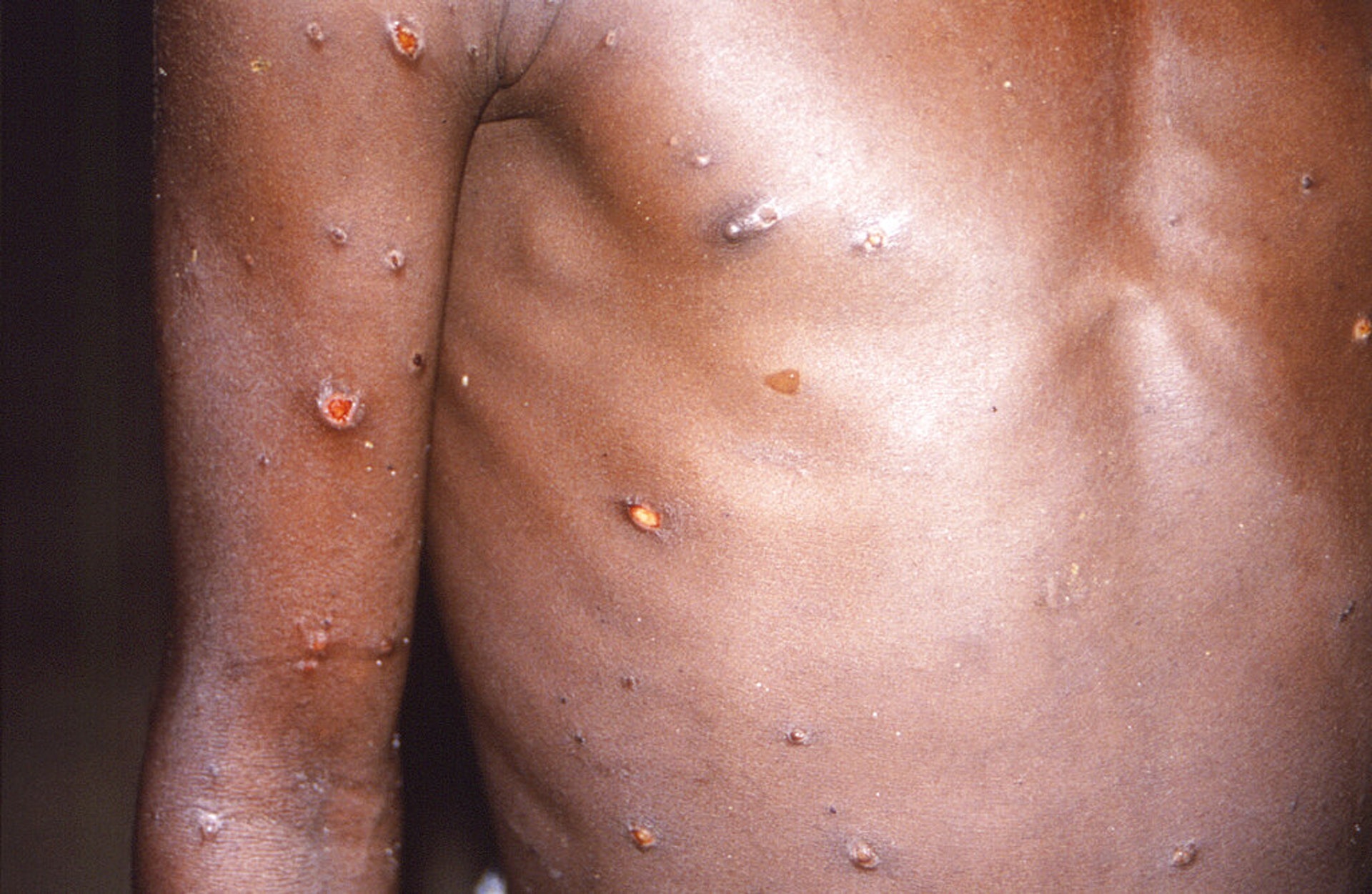 猴痘:FILE - This 1997 image provided by U.S. Centers for Disease Control and Prevention shows the right arm and torso of a patient, whose skin displayed a number of lesions due to what had been an active case of monkeypox.