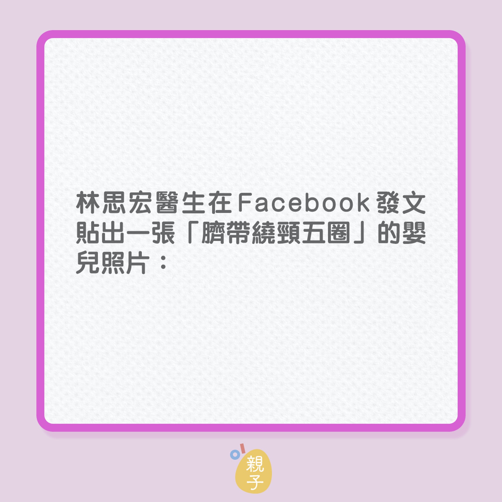 分娩|臍帶繞頸5圈,嬰孩仍順利出世!(01製圖) 分娩|臍帶繞頸5圈,嬰孩仍順利出世!(01製圖)