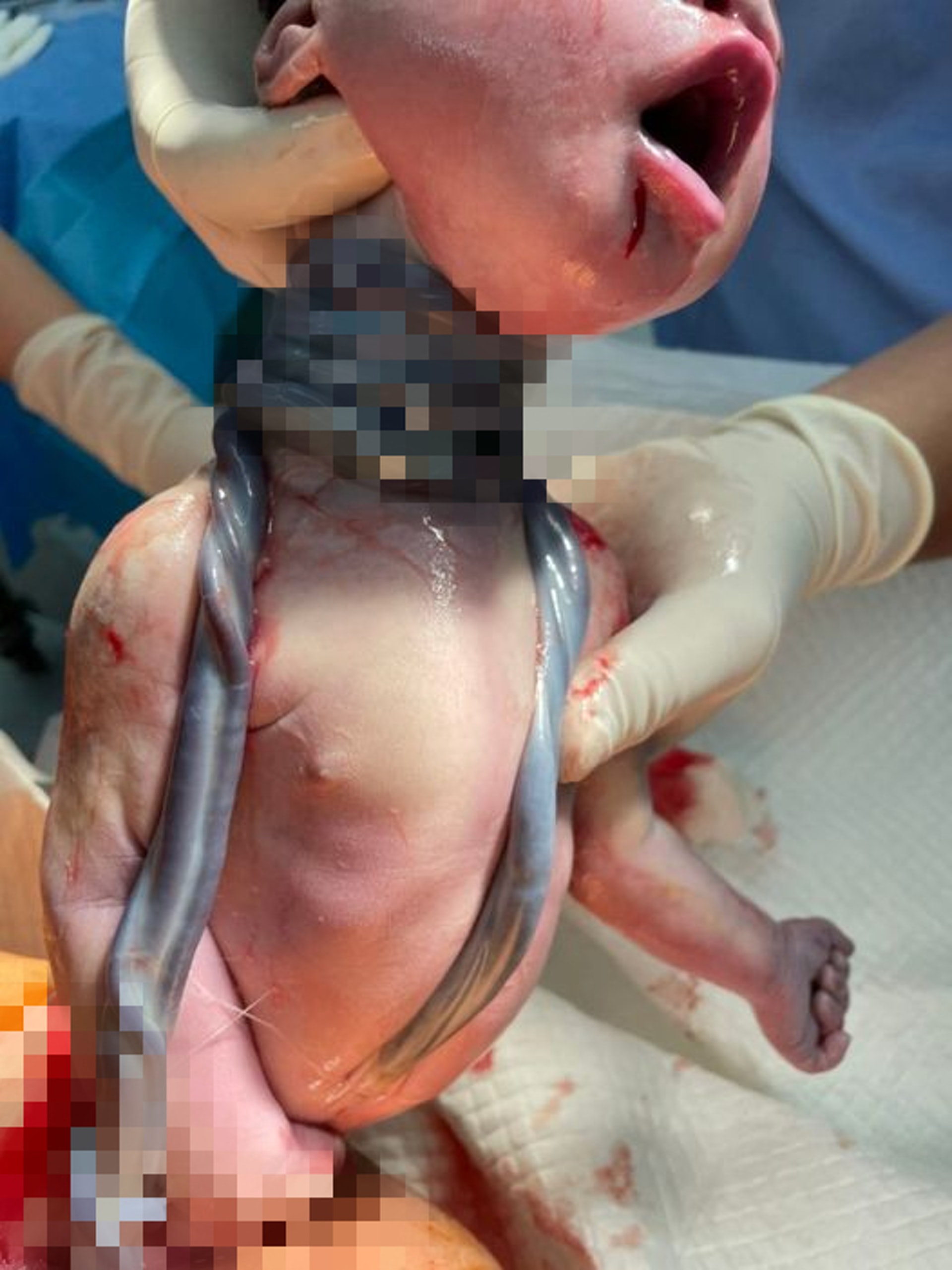 醫生分享臍帶繞頸5圈的嬰兒，照片曝光引發熱議。（圖片經過處理）（Facebook / @林思宏醫師）