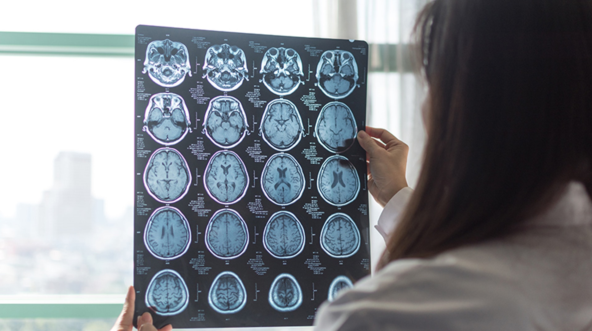 癌症「腦轉移」是指腦部以外的其他身體器官出現原發性癌細胞,而這些癌細胞隨著血液或淋巴系統循環,擴散至腦部並形成腫瘤。(圖片:Shutterstock) 癌症「腦轉移」是指腦部以外的其他身體器官出現原發性癌細胞,而這些癌細胞隨著血液或淋巴系統循環,擴散至腦部並形成腫瘤。(圖片:Shutterstock)