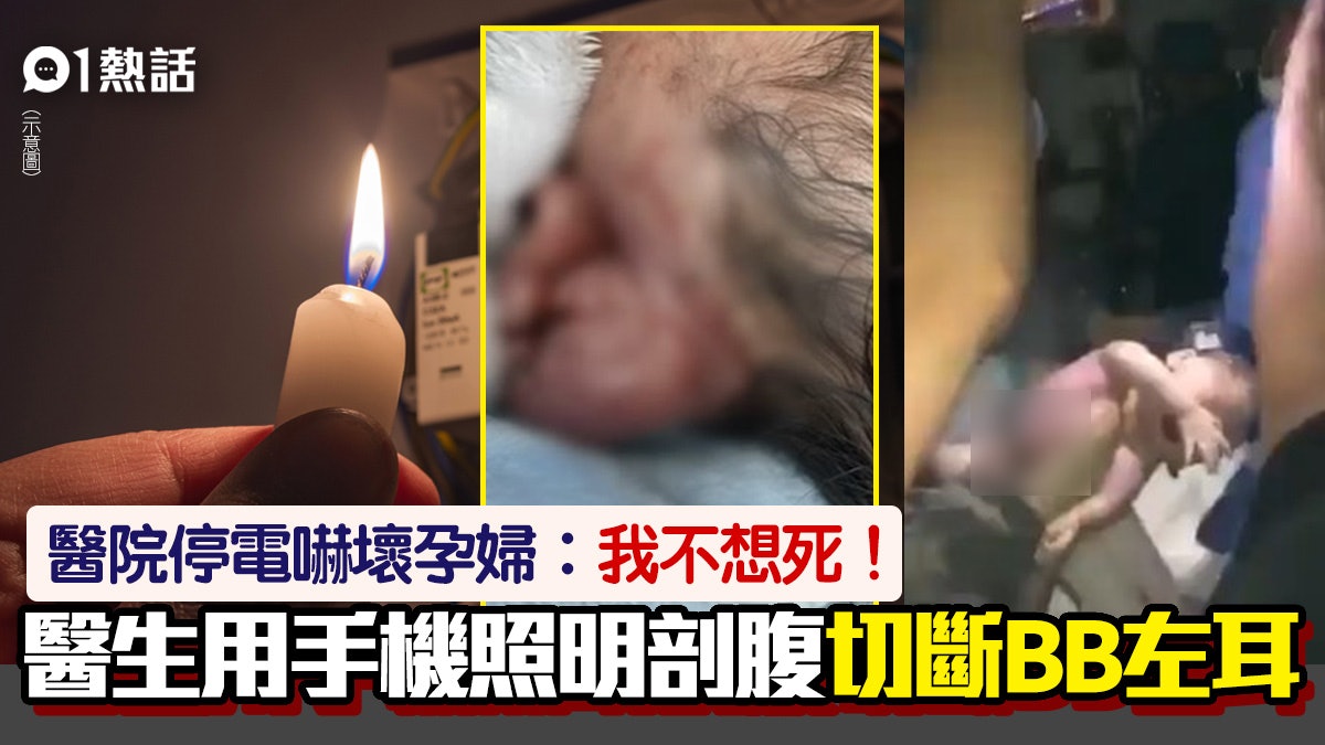 慘!醫院停電孕婦叫停剖腹分娩 醫生堅持開刀 BB左耳慘割成兩半 慘!醫院停電孕婦叫停剖腹分娩 醫生堅持開刀 BB左耳慘割成兩半