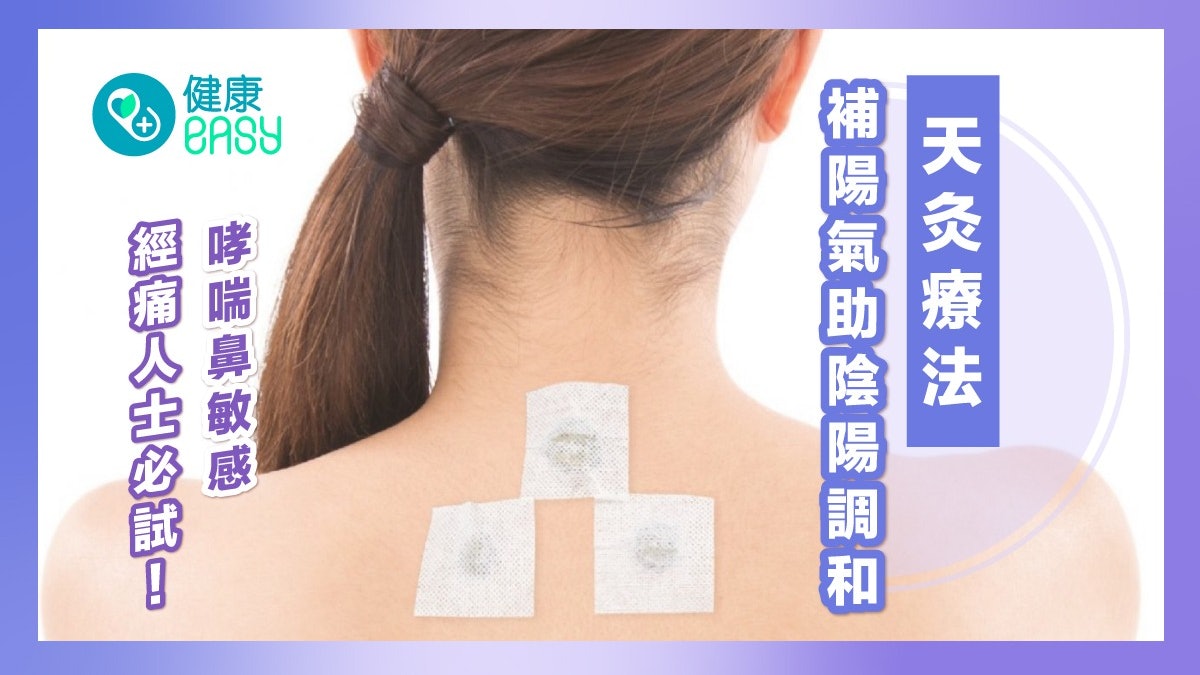 天灸|哮喘鼻敏感經痛人士必試傳統中醫療法!注意事項要知